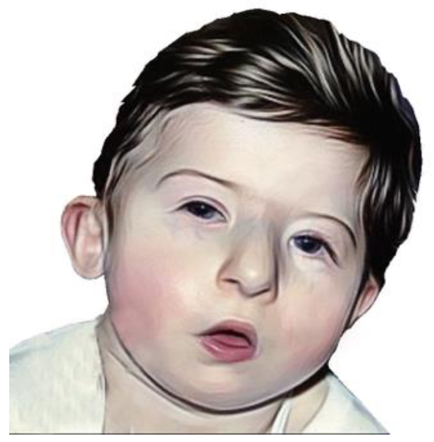 velocardiofacial syndrome facial features