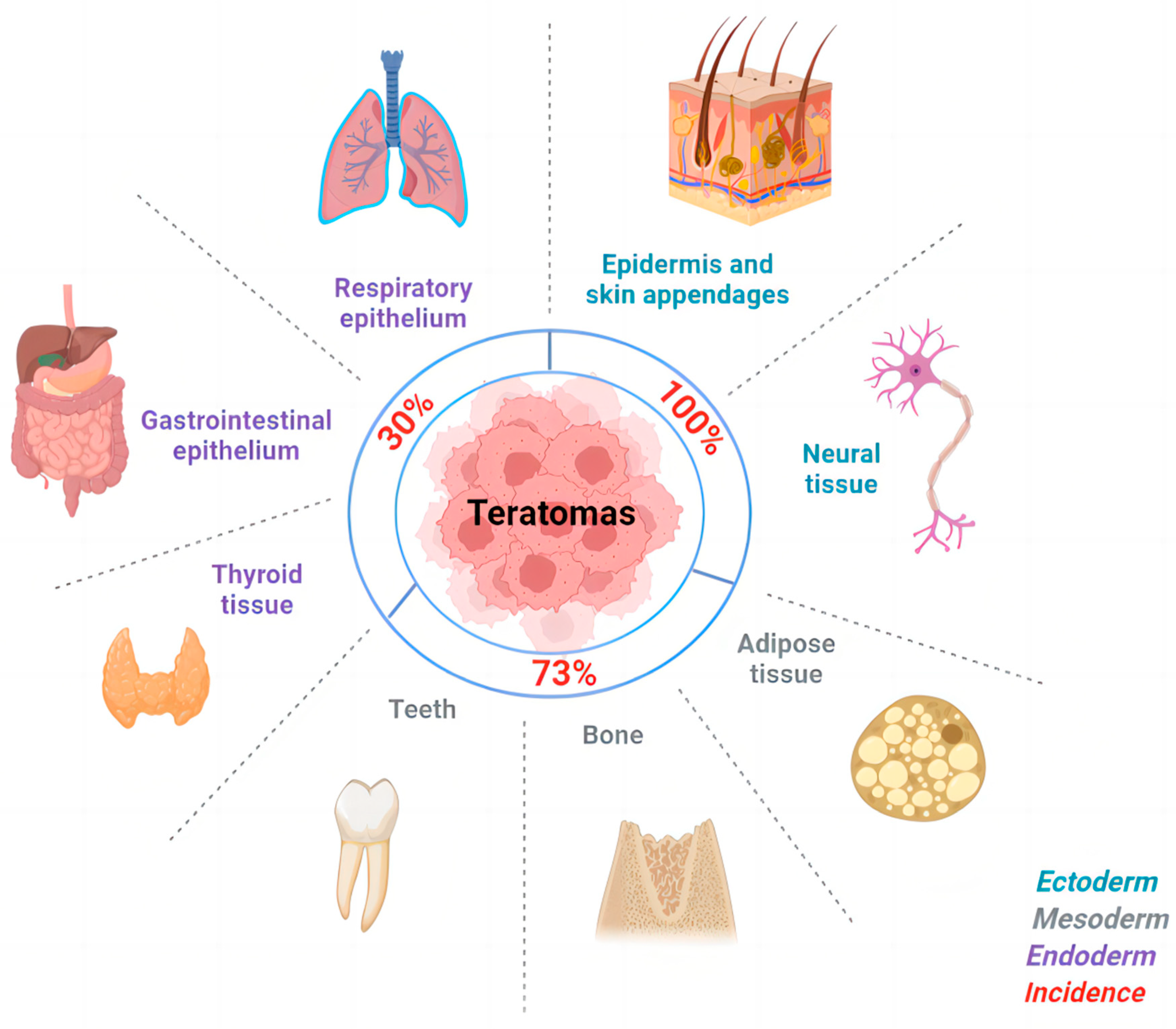 Mature Cystic Teratoma An Integrated Review Mature Cystic Teratoma An Integrated Review