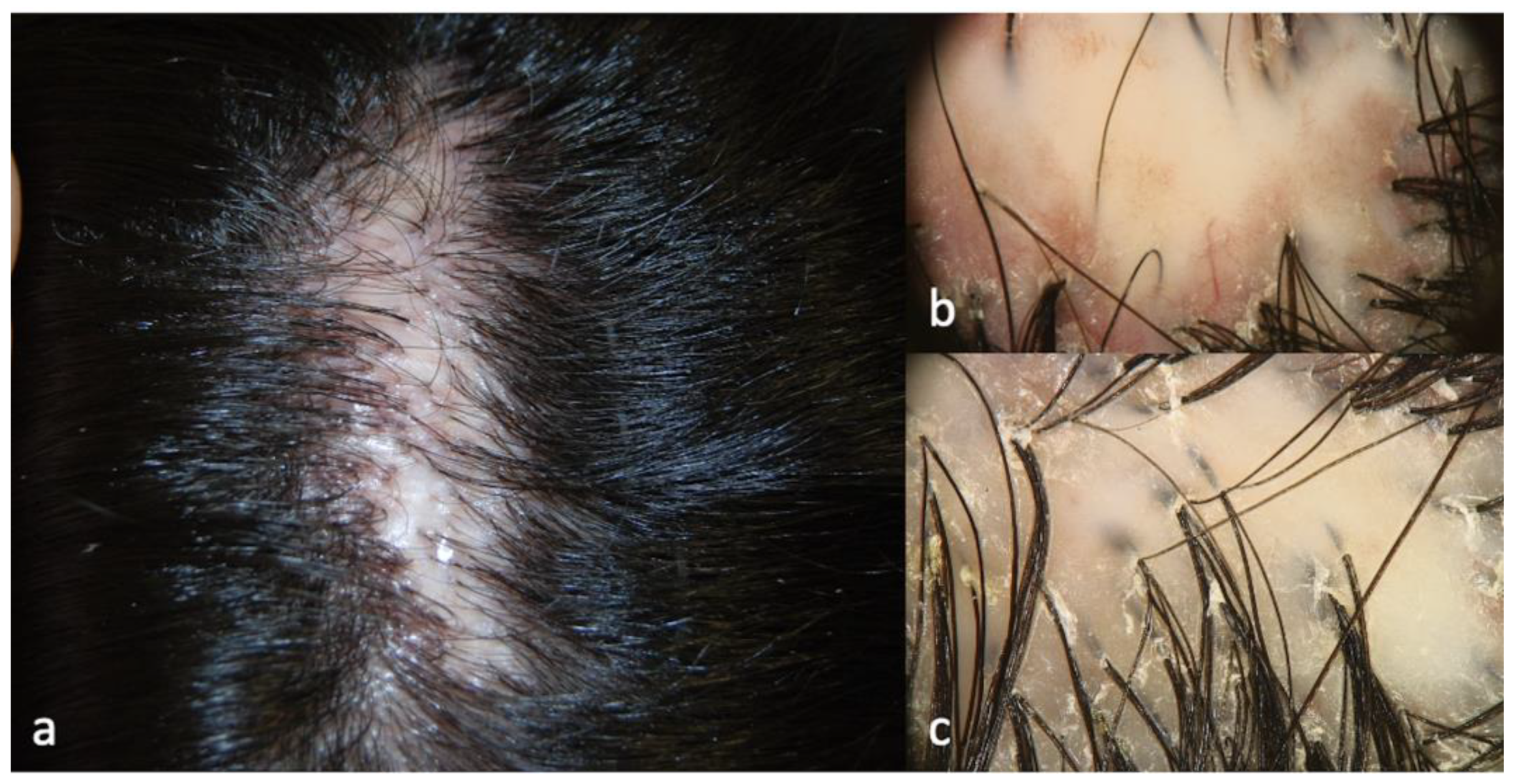 follicular hyperkeratosis scalp