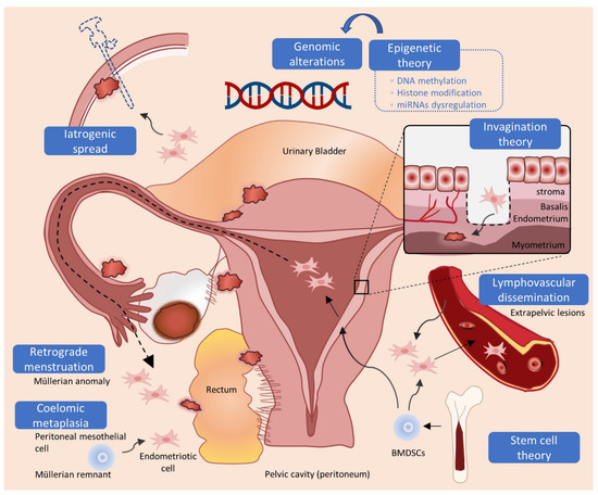 Endometrial tissue implanted in the peritoneum has a varied