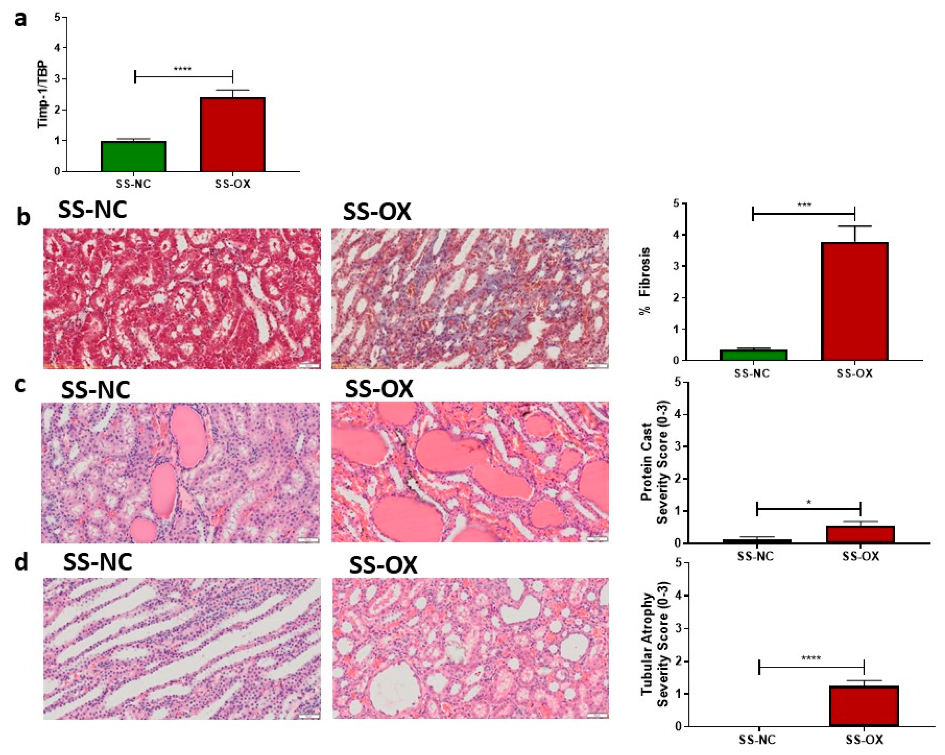High Dietary Protein Exacerbates Hypertension and Renal Damage in Dahl SS  Rats by Increasing Infiltrating Immune Cells in the Kidney