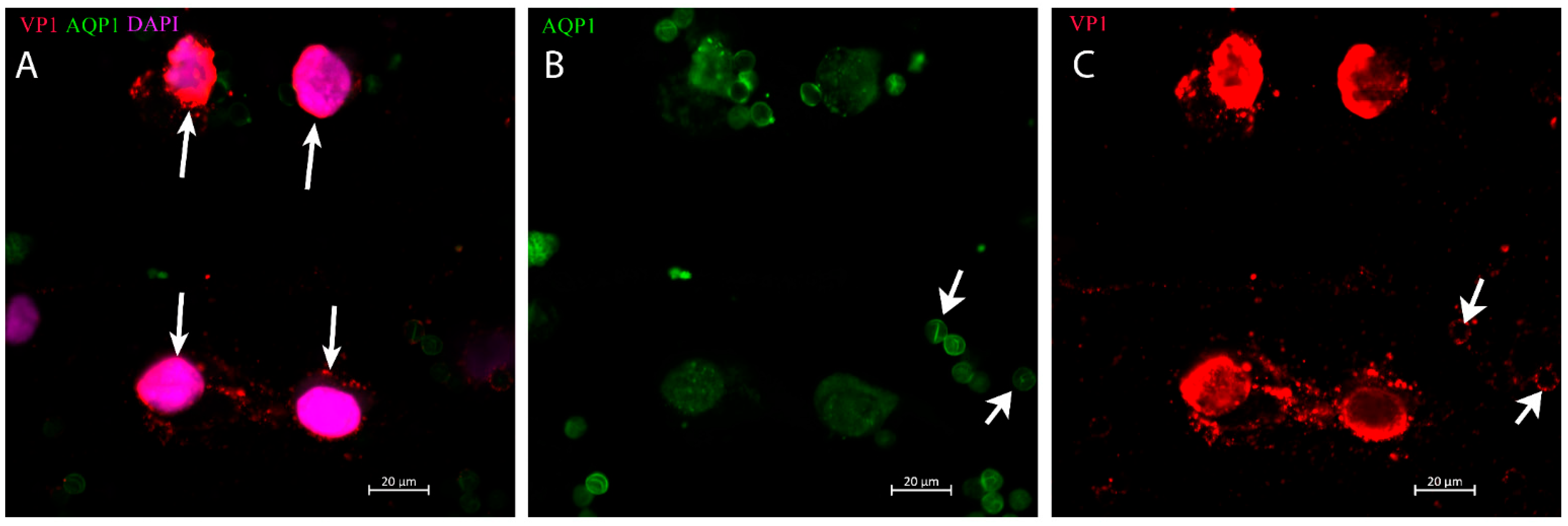 Ijms | free full-text | acute kidney injury and bk polyomavirus in