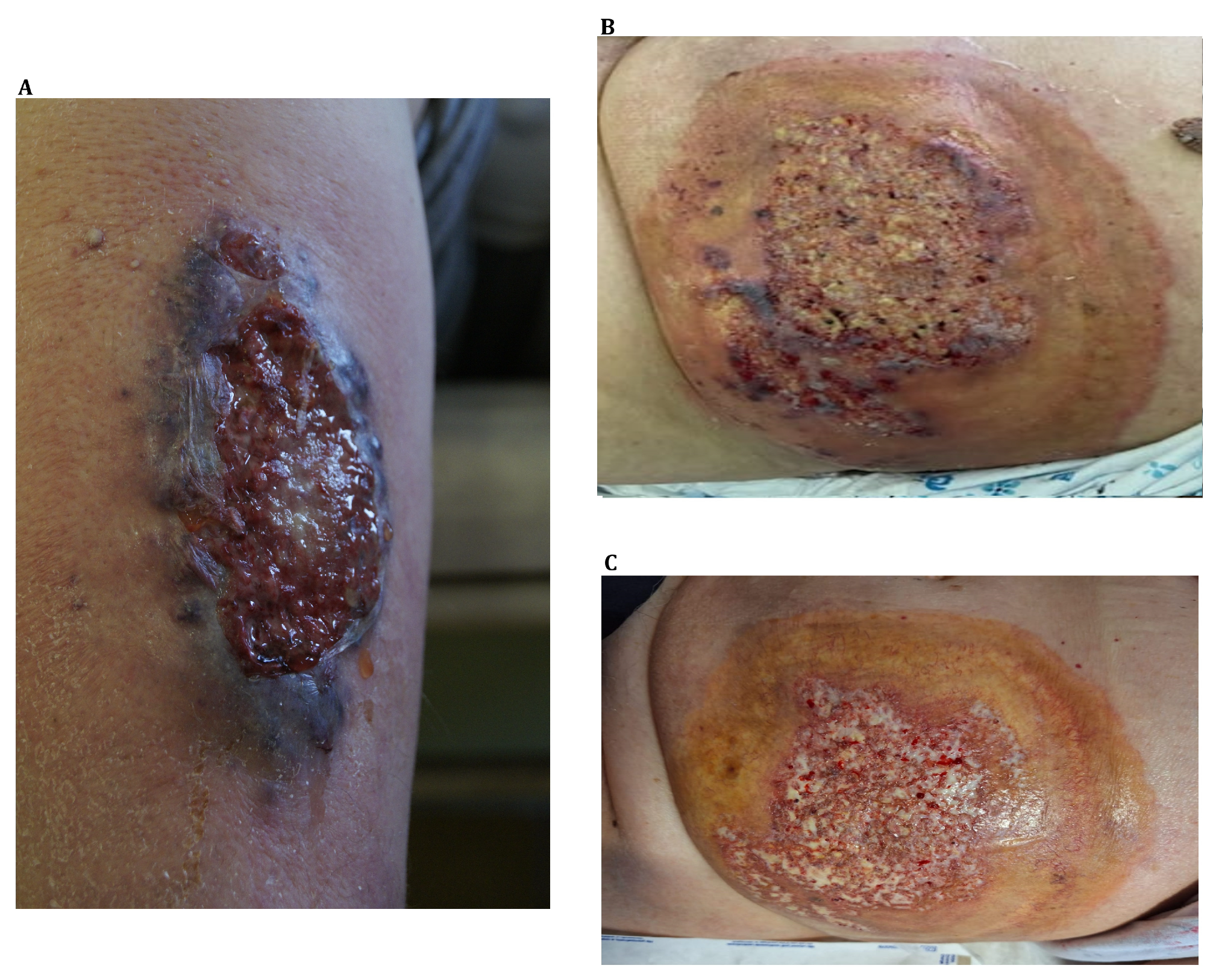 The Pathophysiology And Treatment Of Pyoderma Gangrenosum Current The Pathophysiology And Treatment Of Pyoderma Gangrenosum Current