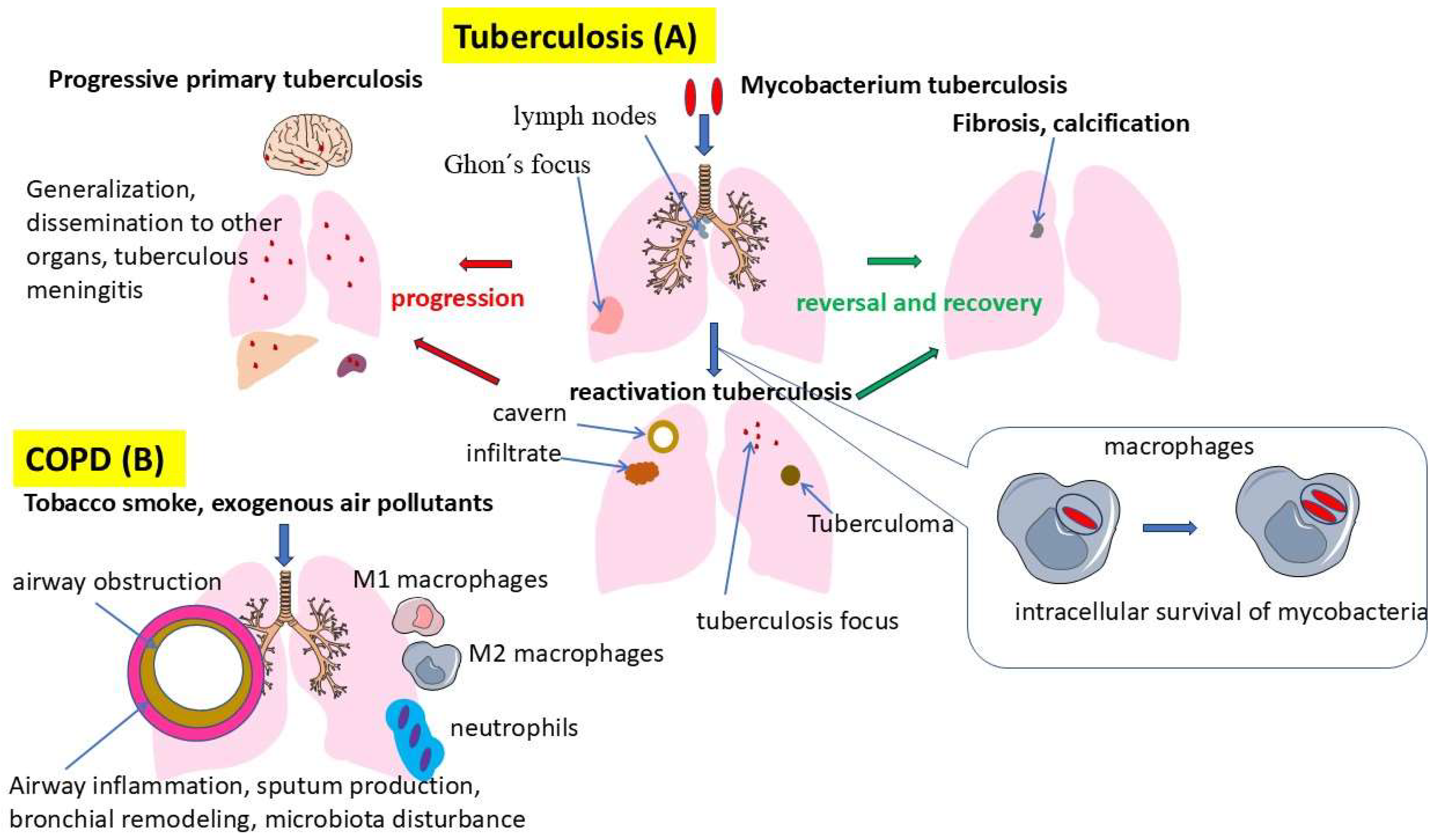 The Role of Inflammation in the Pathogenesis of Comorbidity of Chronic ...