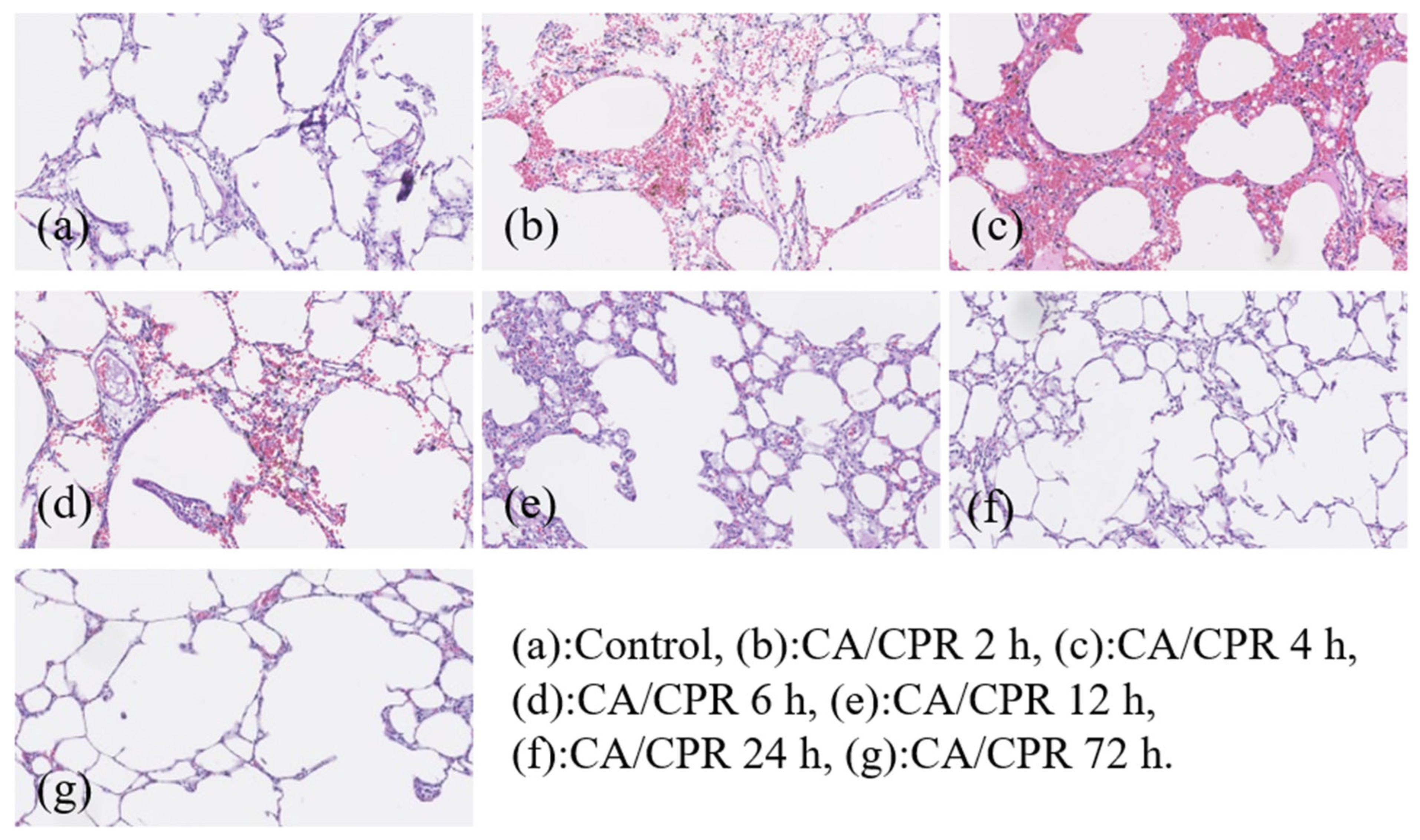 Serial Expression of Pro-Inflammatory Biomarkers in Acute Lung Injury ...