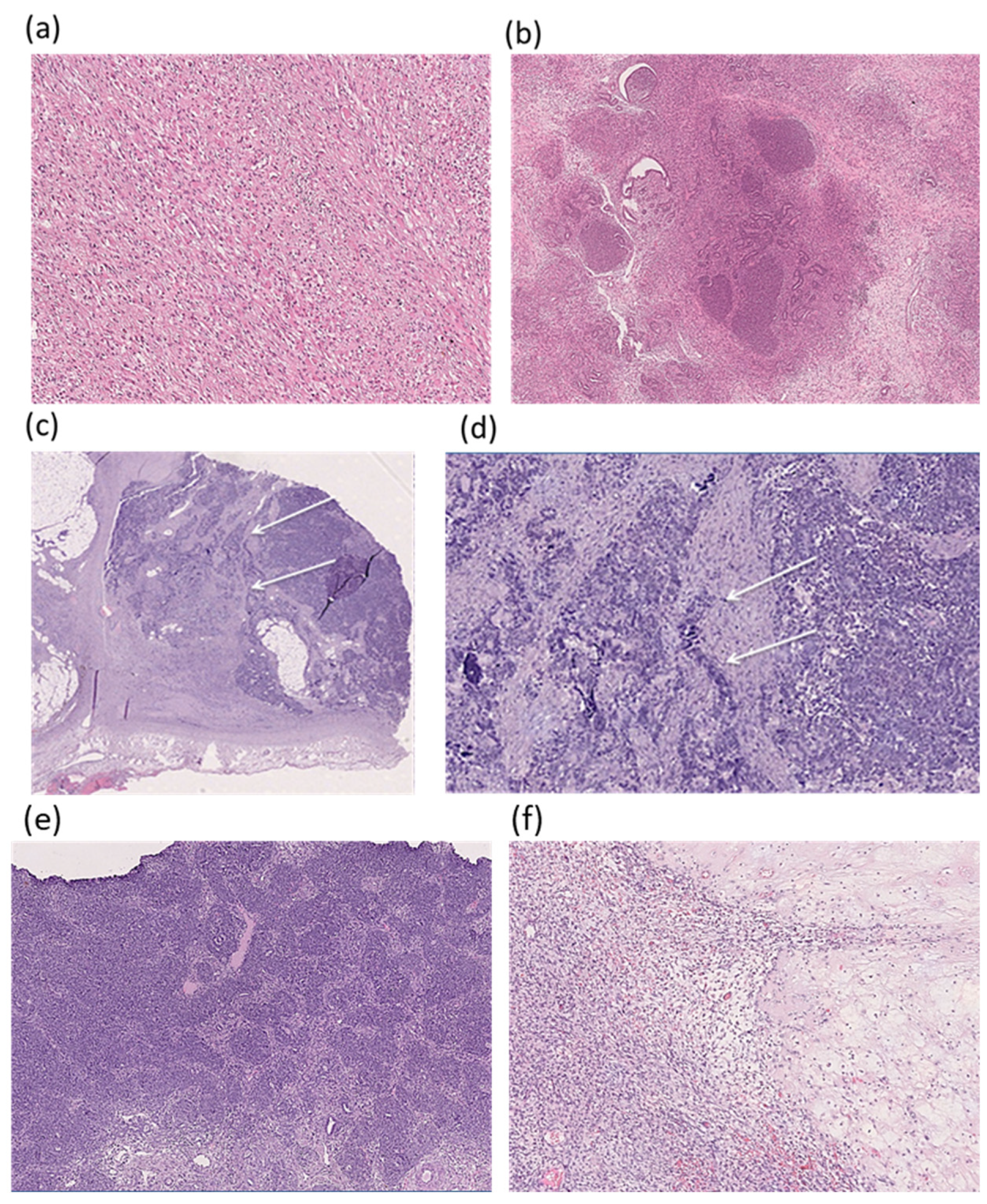 Genetic and Epigenetic Drivers of Wilms Tumor Predisposition in Russian ...