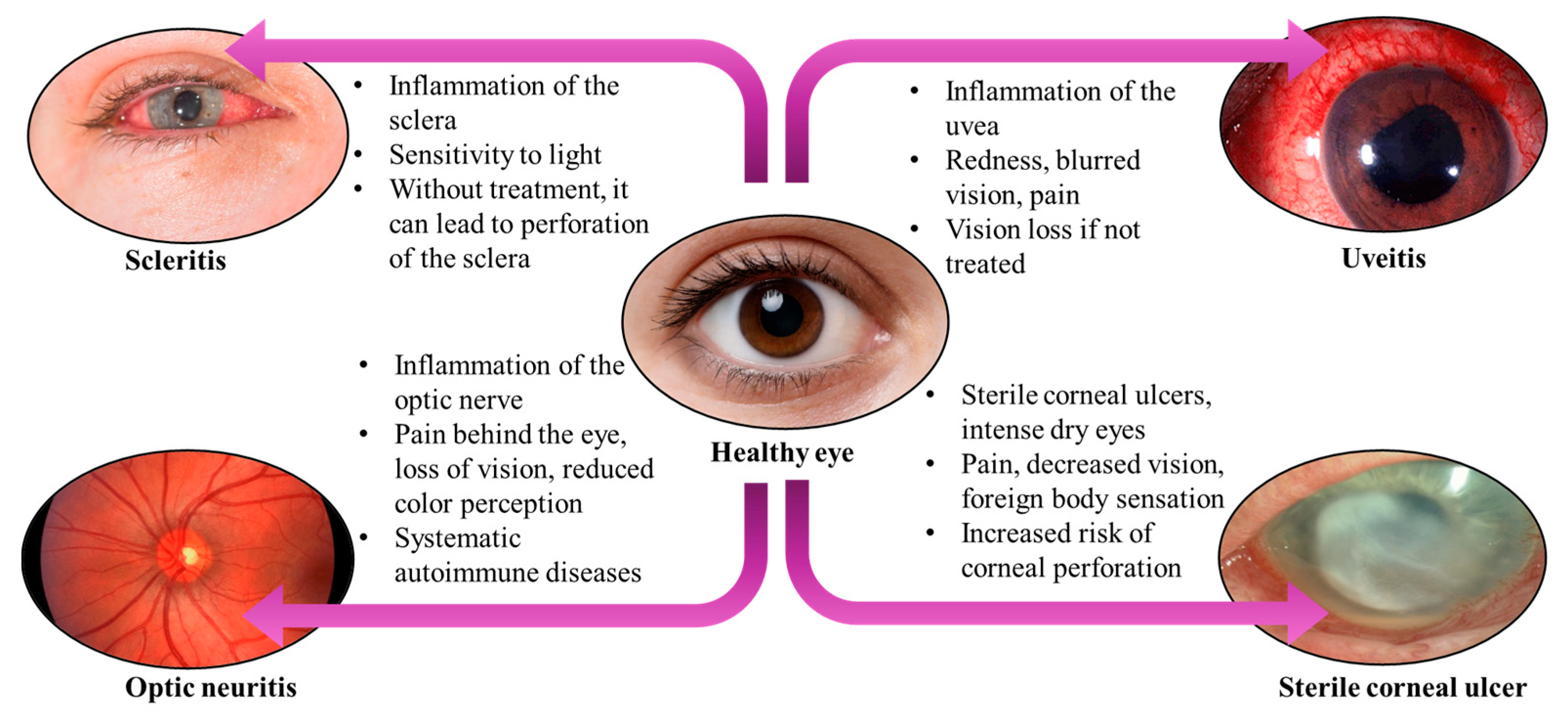 Sj gren s Syndrome And Ocular Inflammation Pathophysiology Clinical Sj gren s Syndrome And Ocular Inflammation Pathophysiology Clinical
