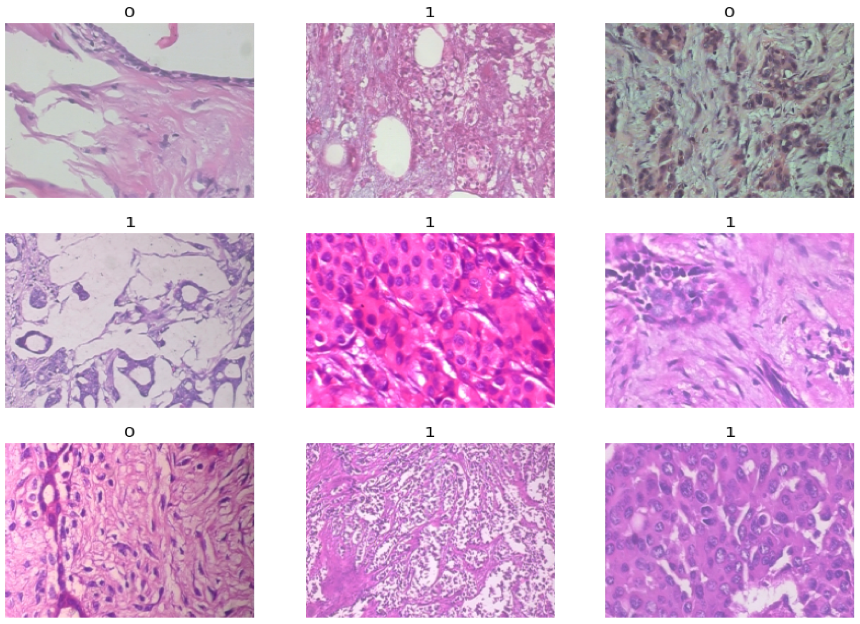 Application of VGG16 Transfer Learning for Breast Cancer Detection