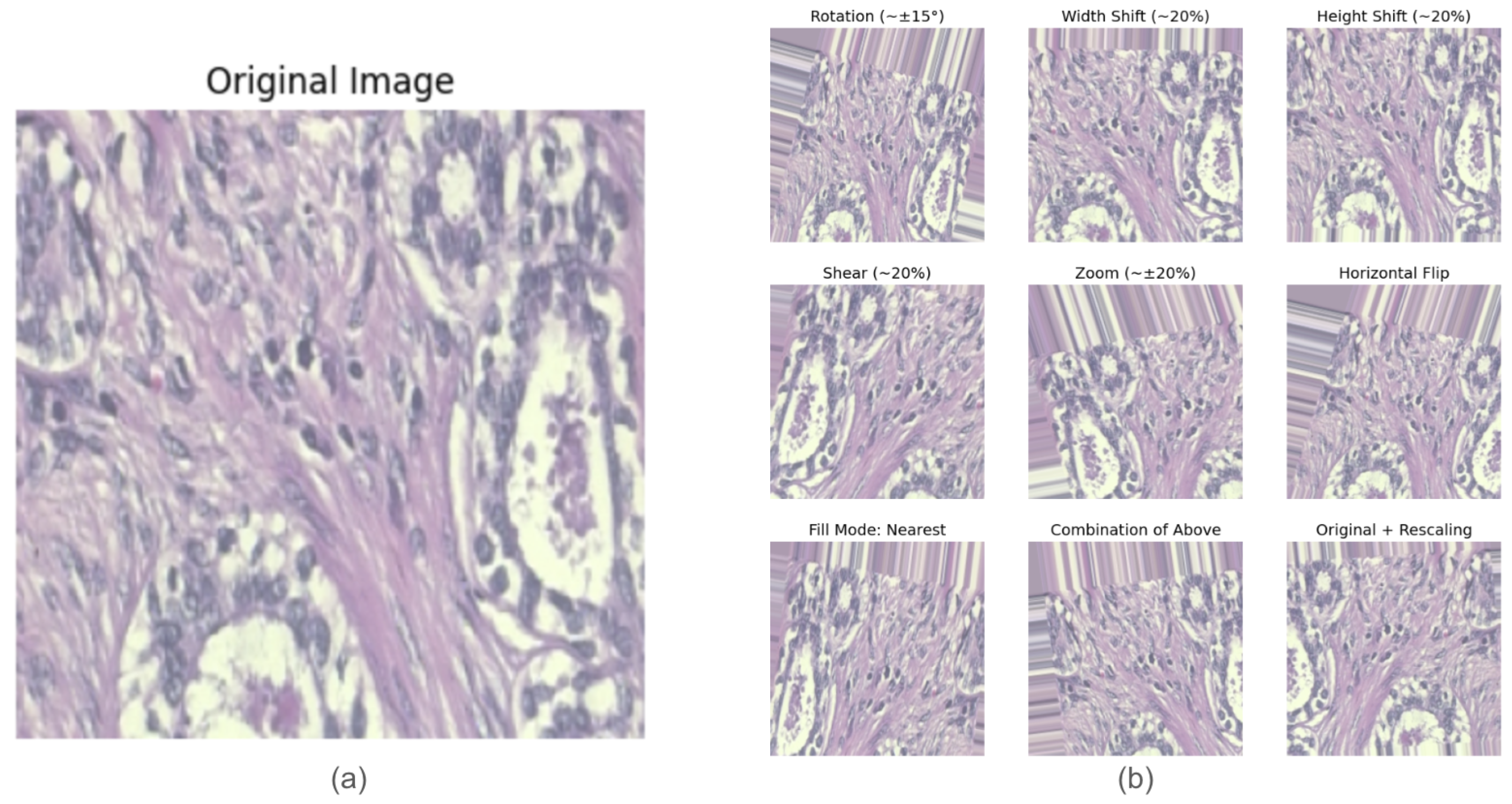 Application of VGG16 Transfer Learning for Breast Cancer Detection