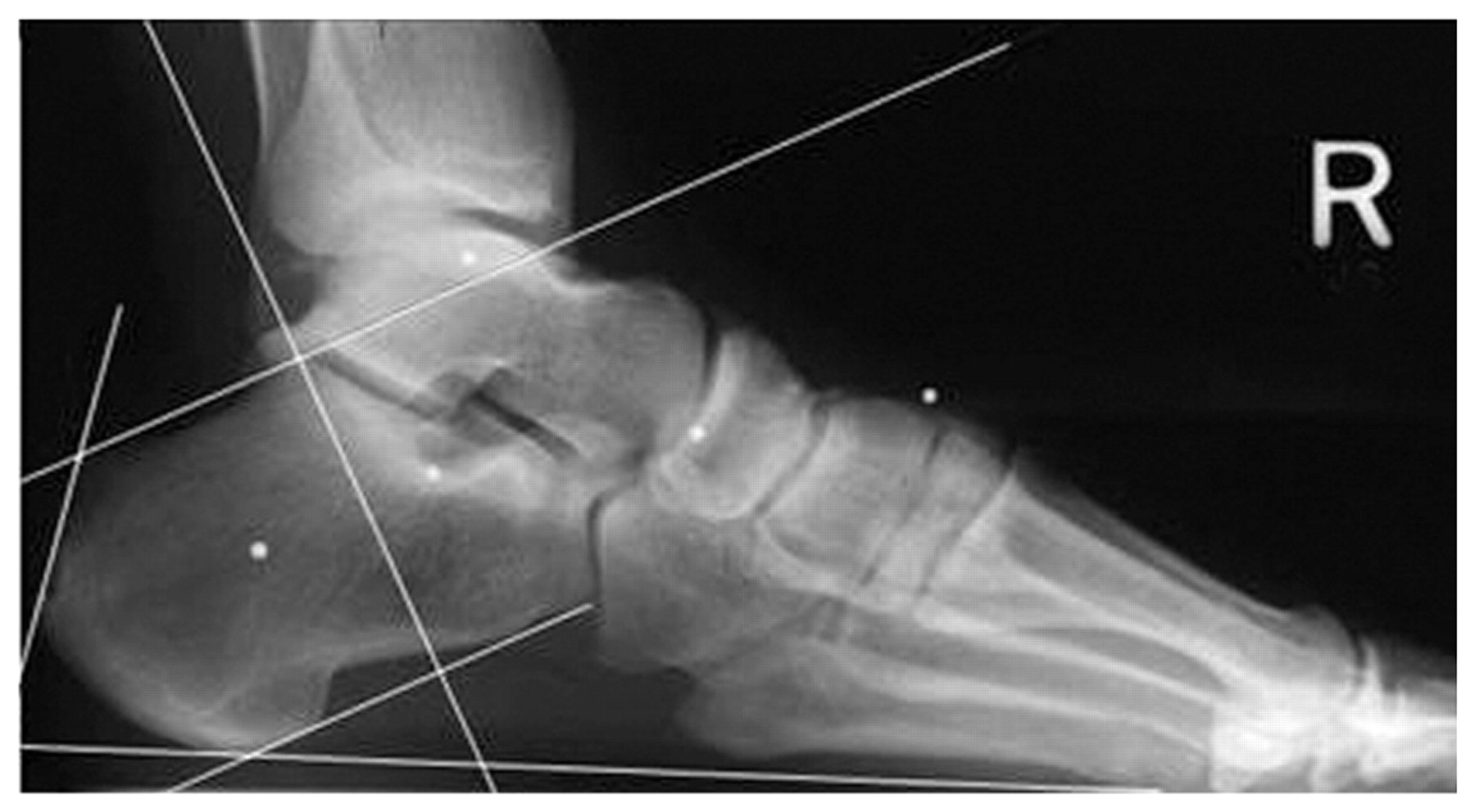 Ncsp Rcsp Radiographic Analysis of Haglund’s Deformity: An Evaluation of NCSP and ...