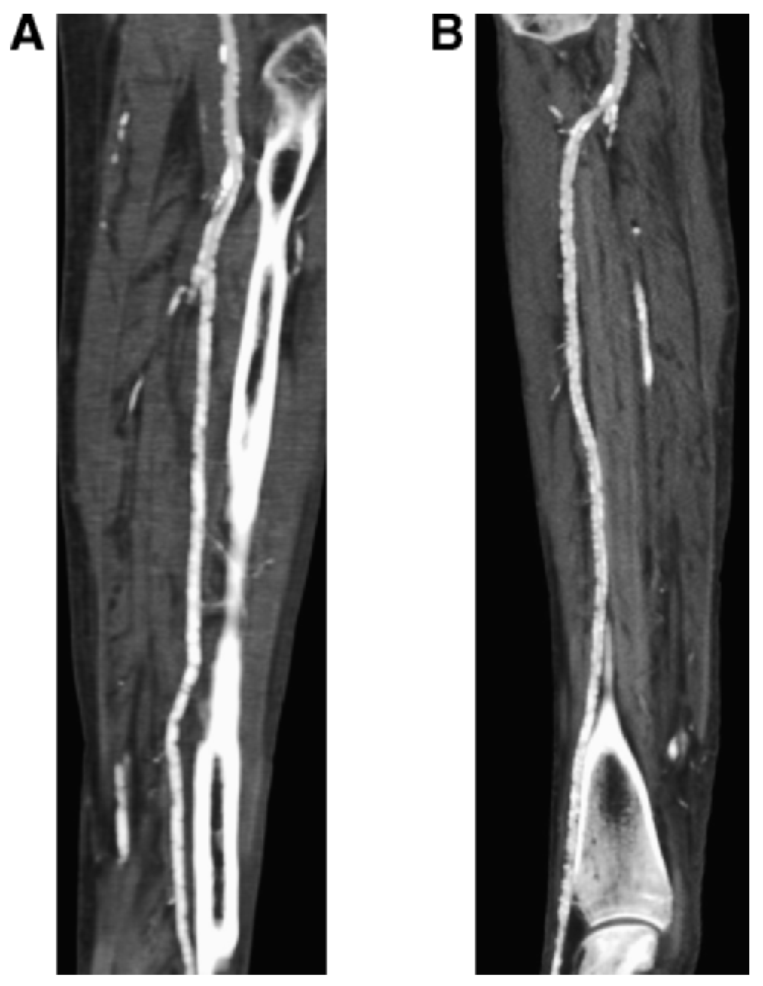 Arterial Imaging in Patients with Lower-extremity Ischemia and Diabetes ...