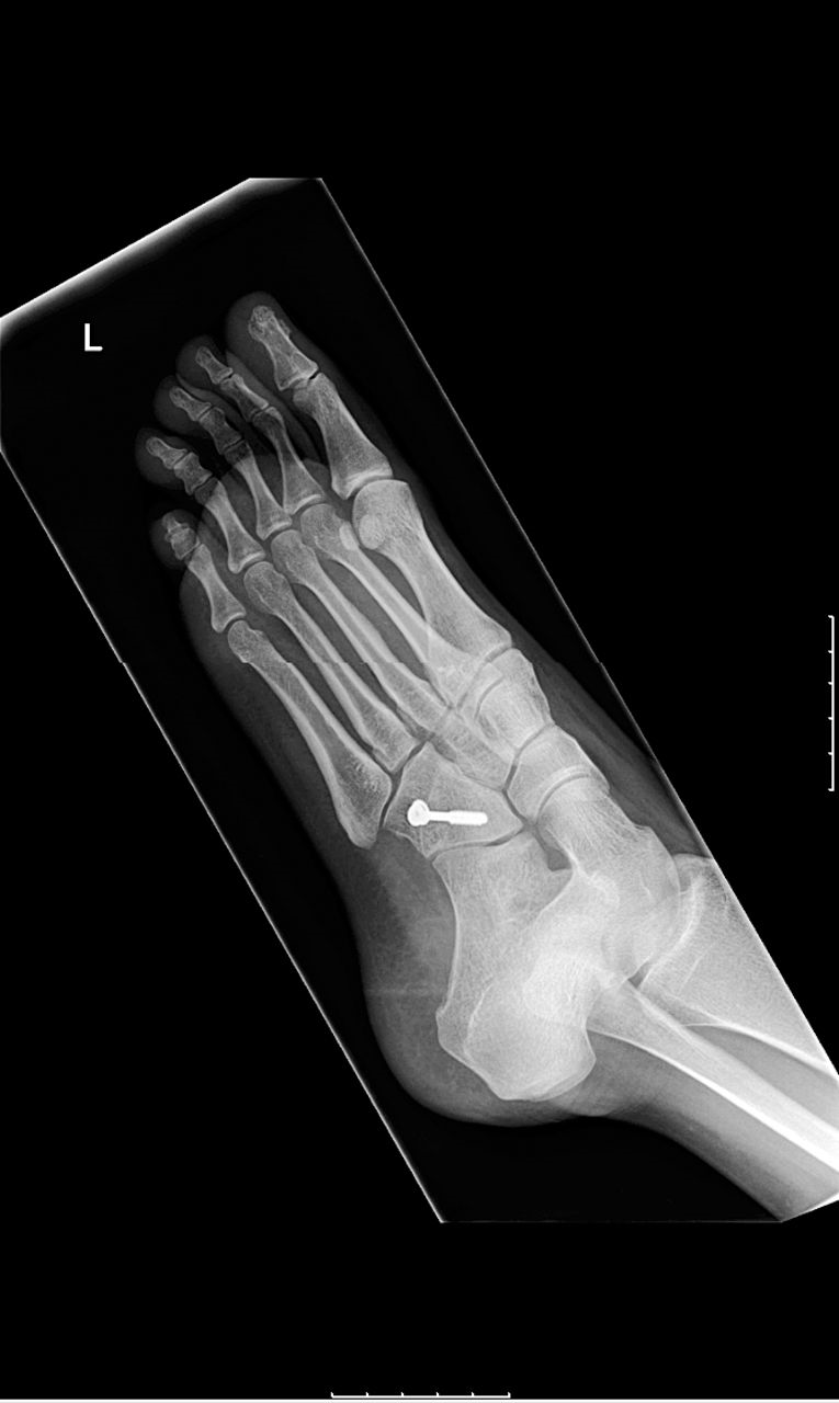 Cuboid Fraqcture Nonunion of an Isolated Cuboid Fracture. A Case Report