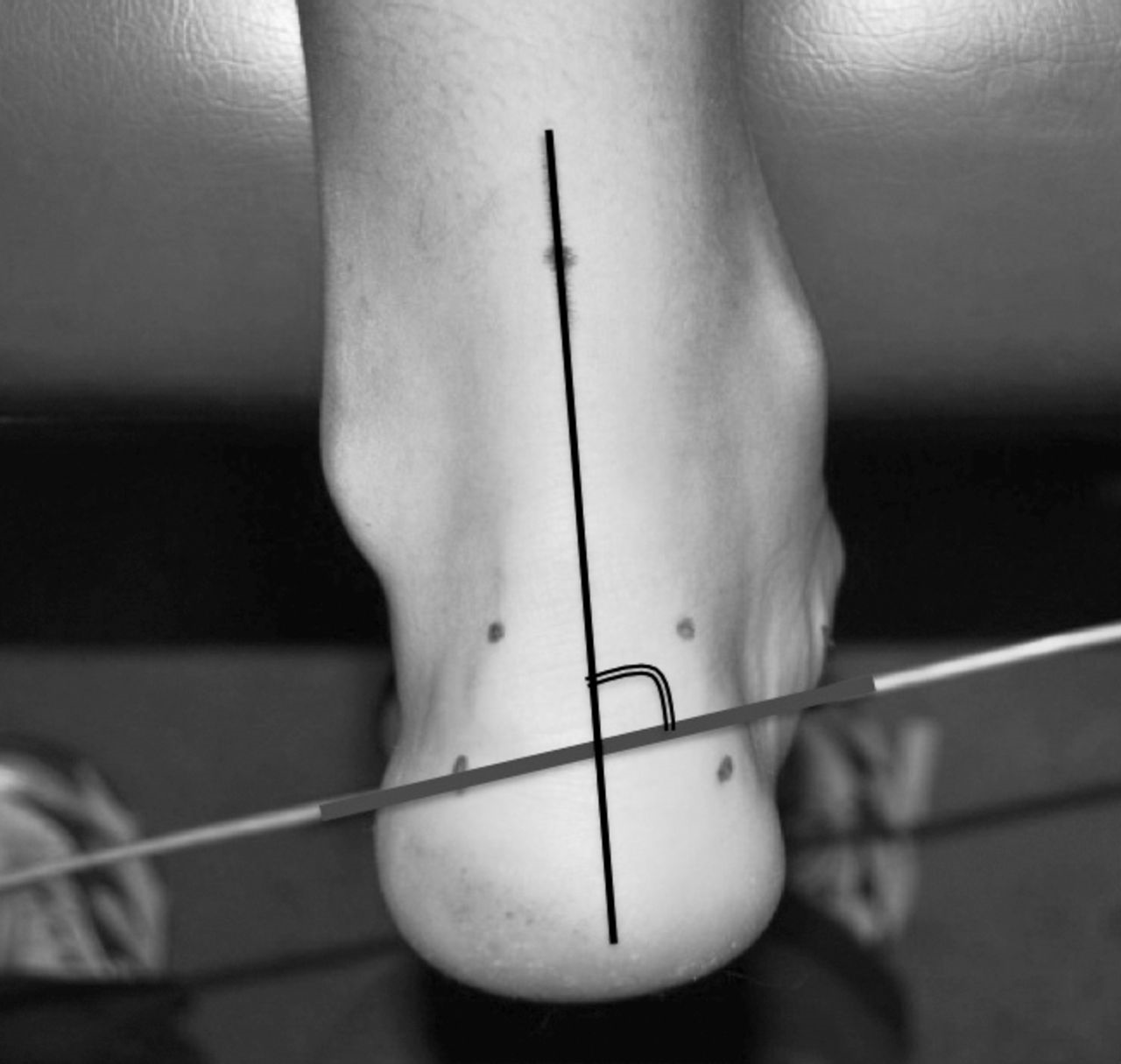A Quick and Reliable Procedure for Assessing Foot Alignment in Athletes