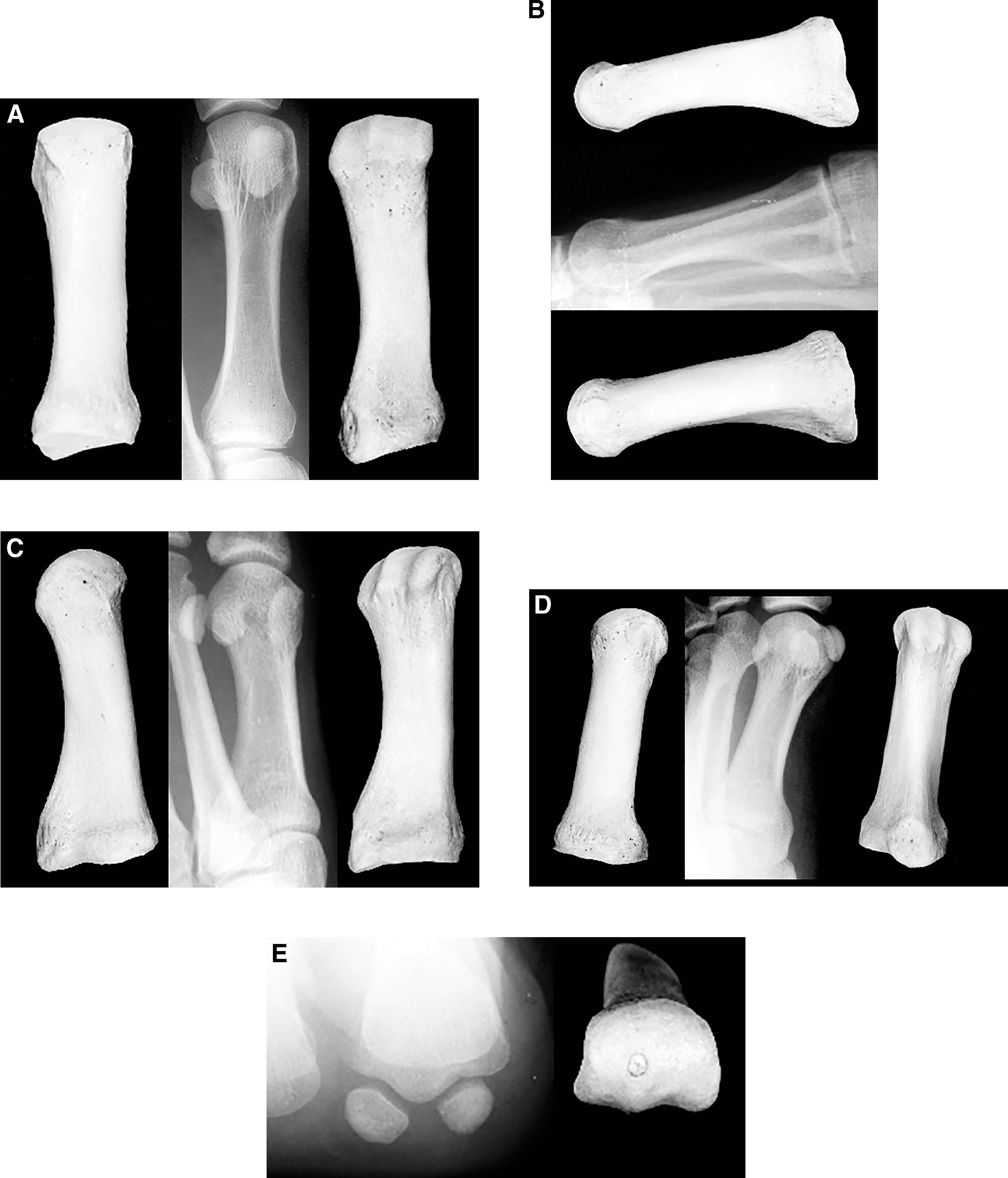 Metatarsal Modifiers Radiographic Anatomy of the Foot and Ankle—Part 4. The Metatarsals