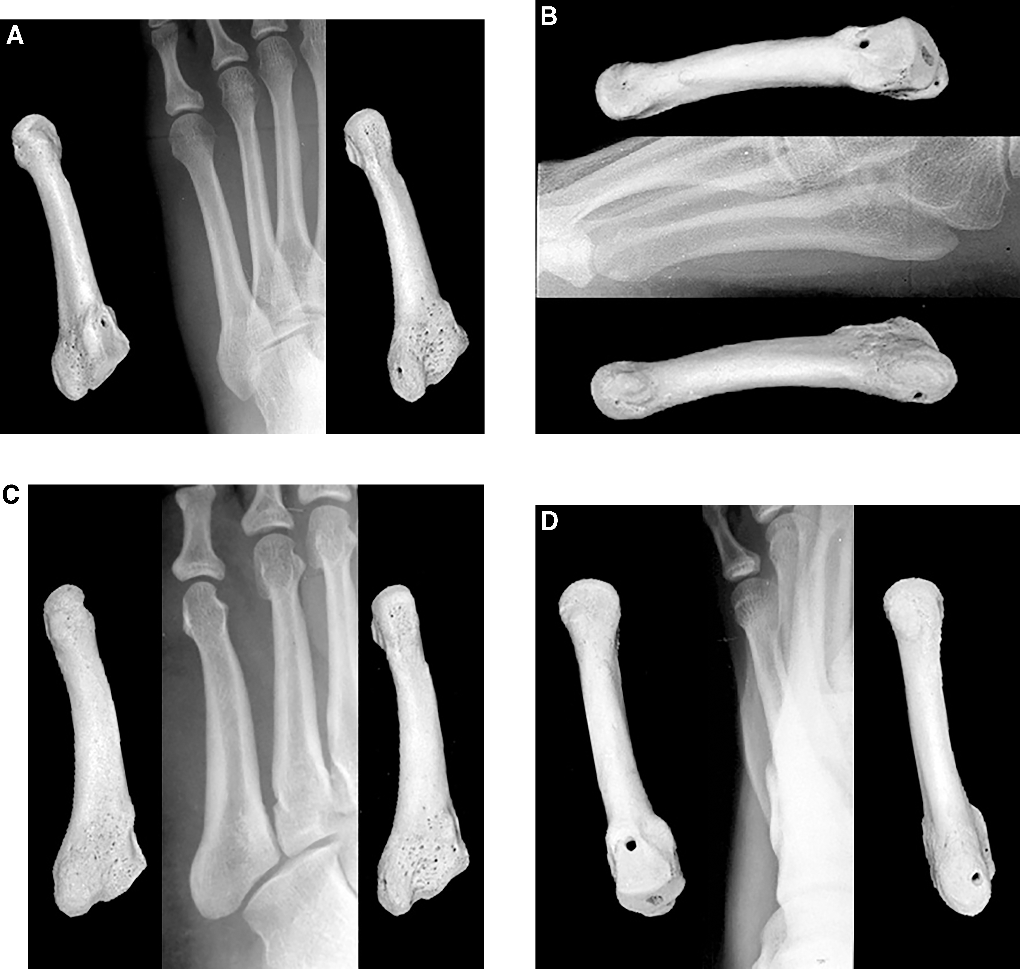 Metatarsal Modifiers Radiographic Anatomy of the Foot and Ankle—Part 4. The Metatarsals
