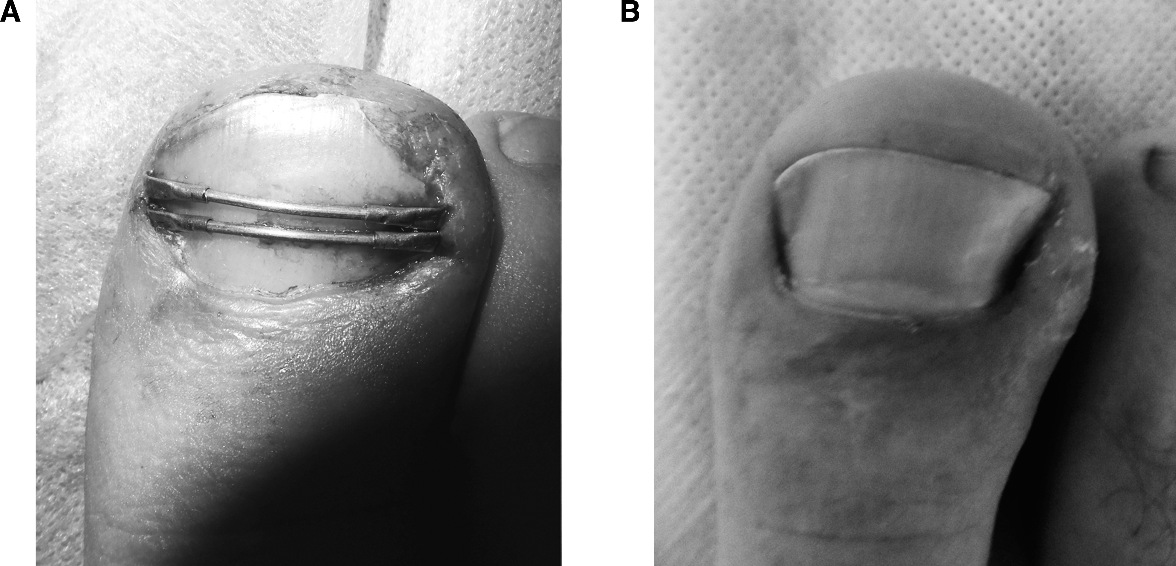 Toenail Toenail Method Treatment of Ingrown Toenail with a Shape Memory Alloy Device
