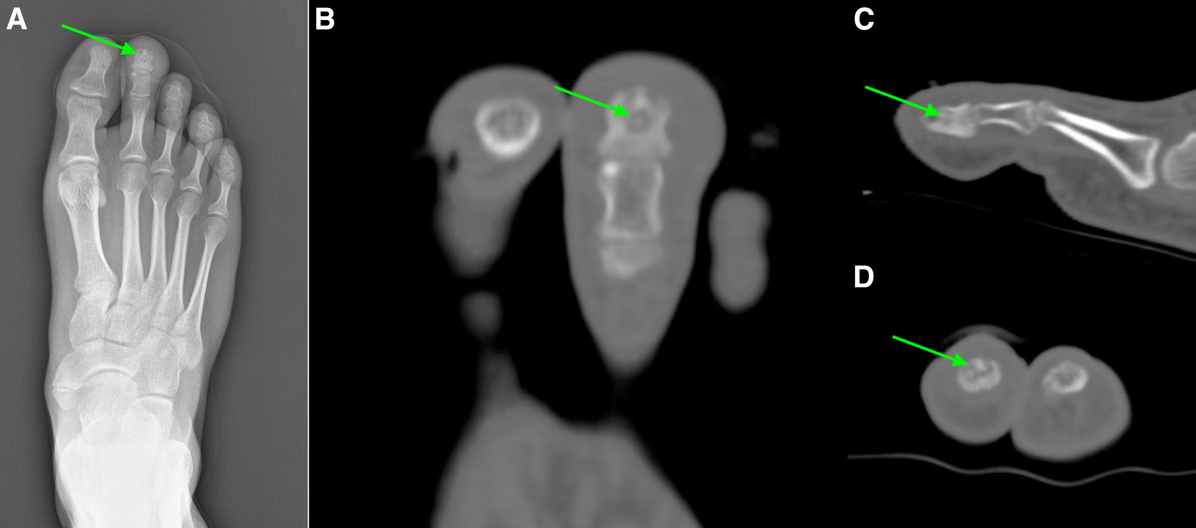 Osteoid Osteoma of the Distal Phalanx of the Foot: An Atypical Location