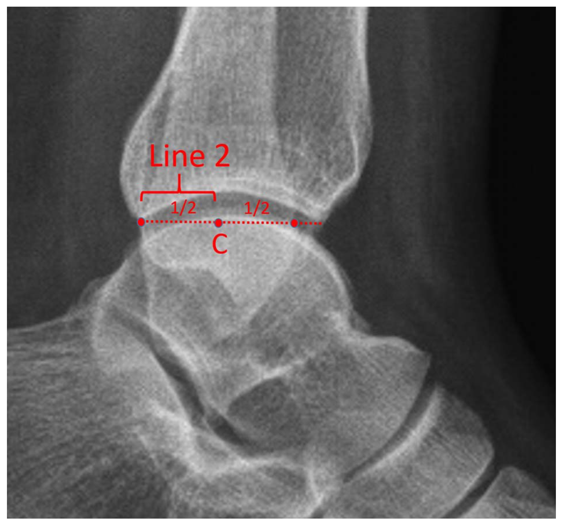 A New Reference to Evaluate Syndesmosis in Sagittal Plane Radiographs ...