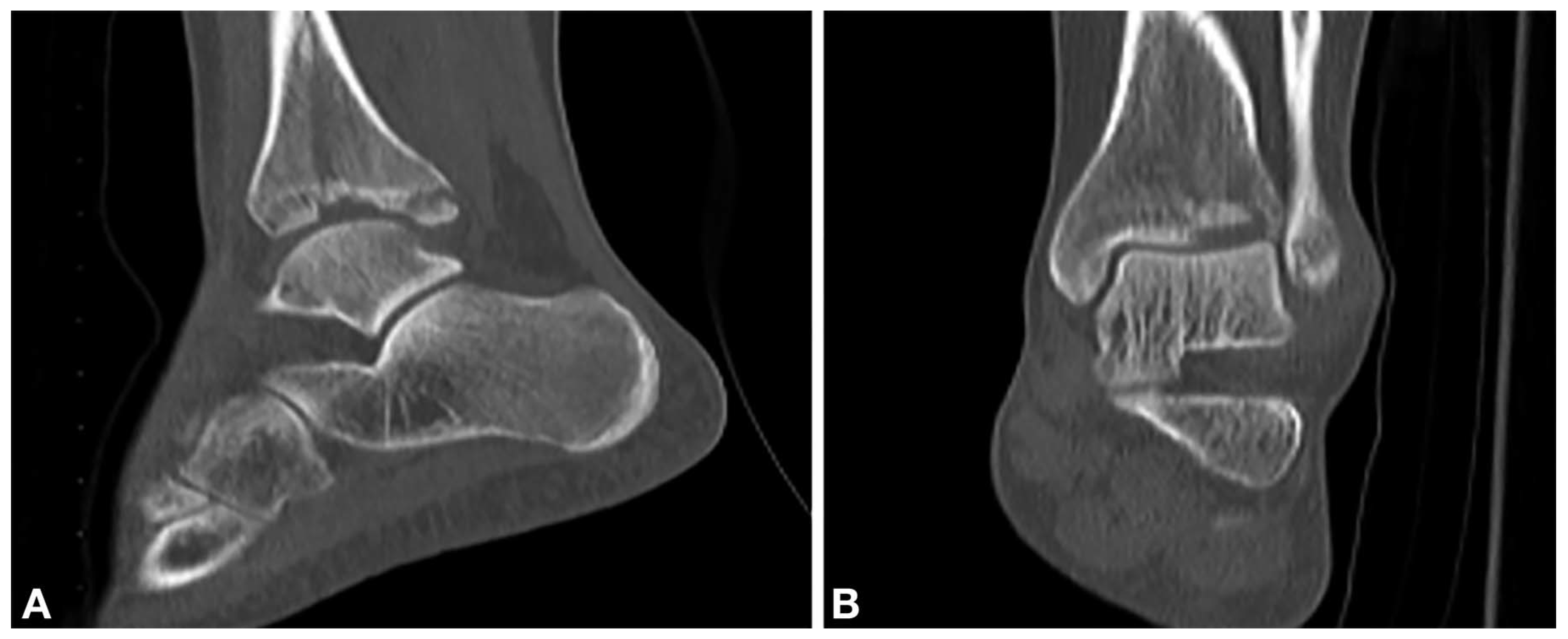 Lateral Transfibular Approach to Tibial Pilon Fractures: A Case Report