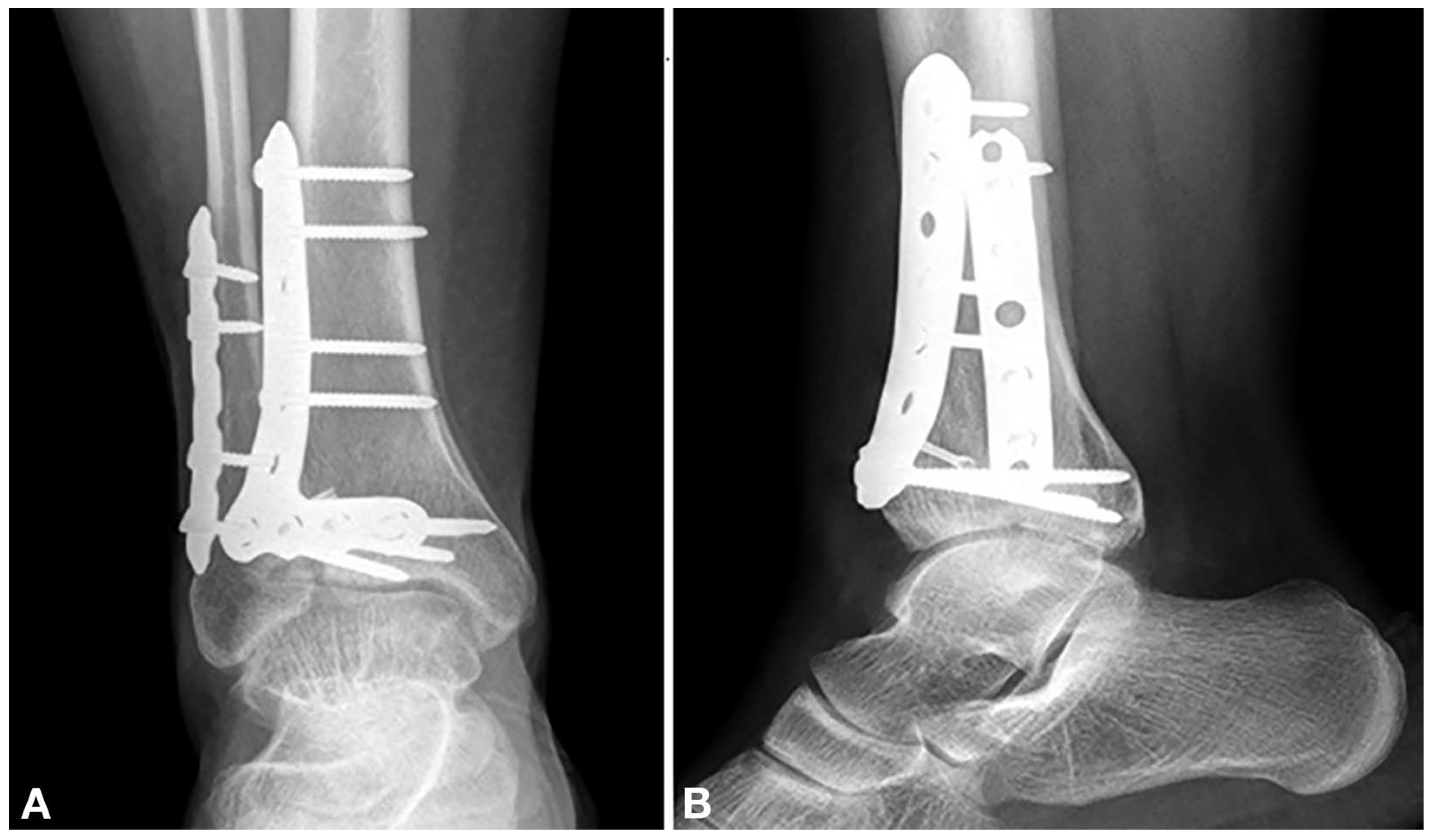 Lateral Transfibular Approach to Tibial Pilon Fractures: A Case Report