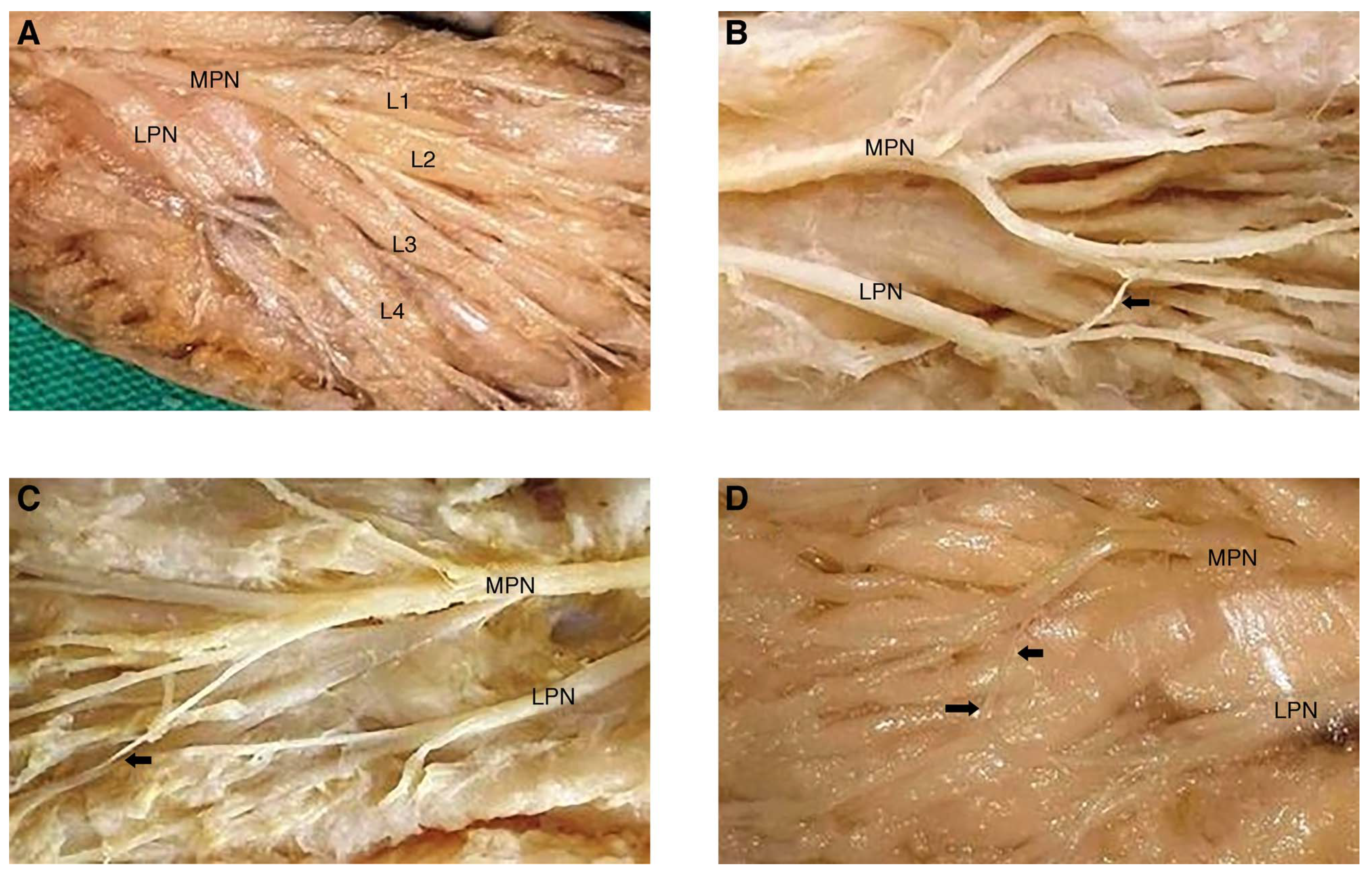 Muscle Innervation Pattern Innervation Patterns of the Lumbrical Muscles of the Foot in Human Fetuses