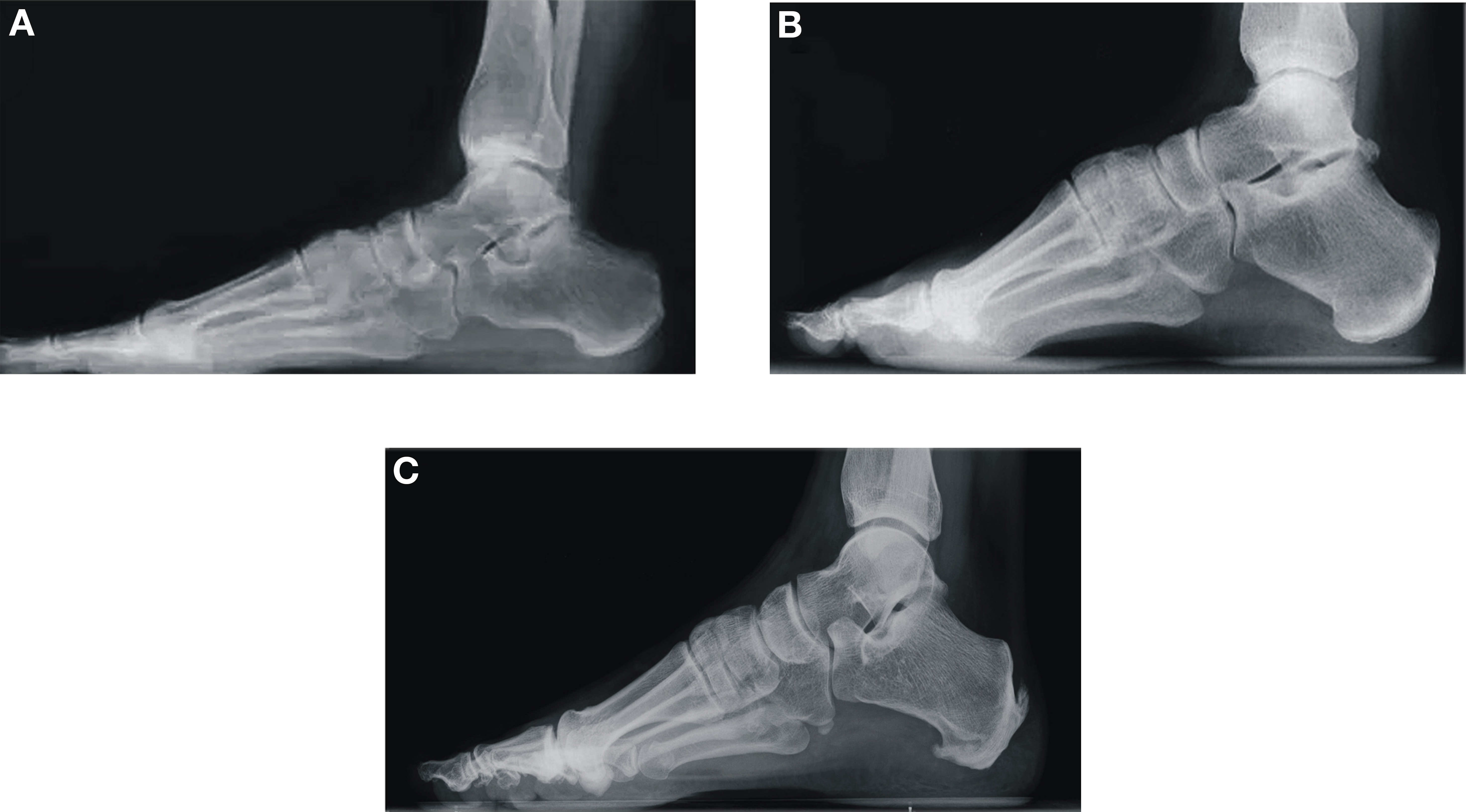 The Evaluation of Radiologic Angular Measurements in Patients with Foot ...