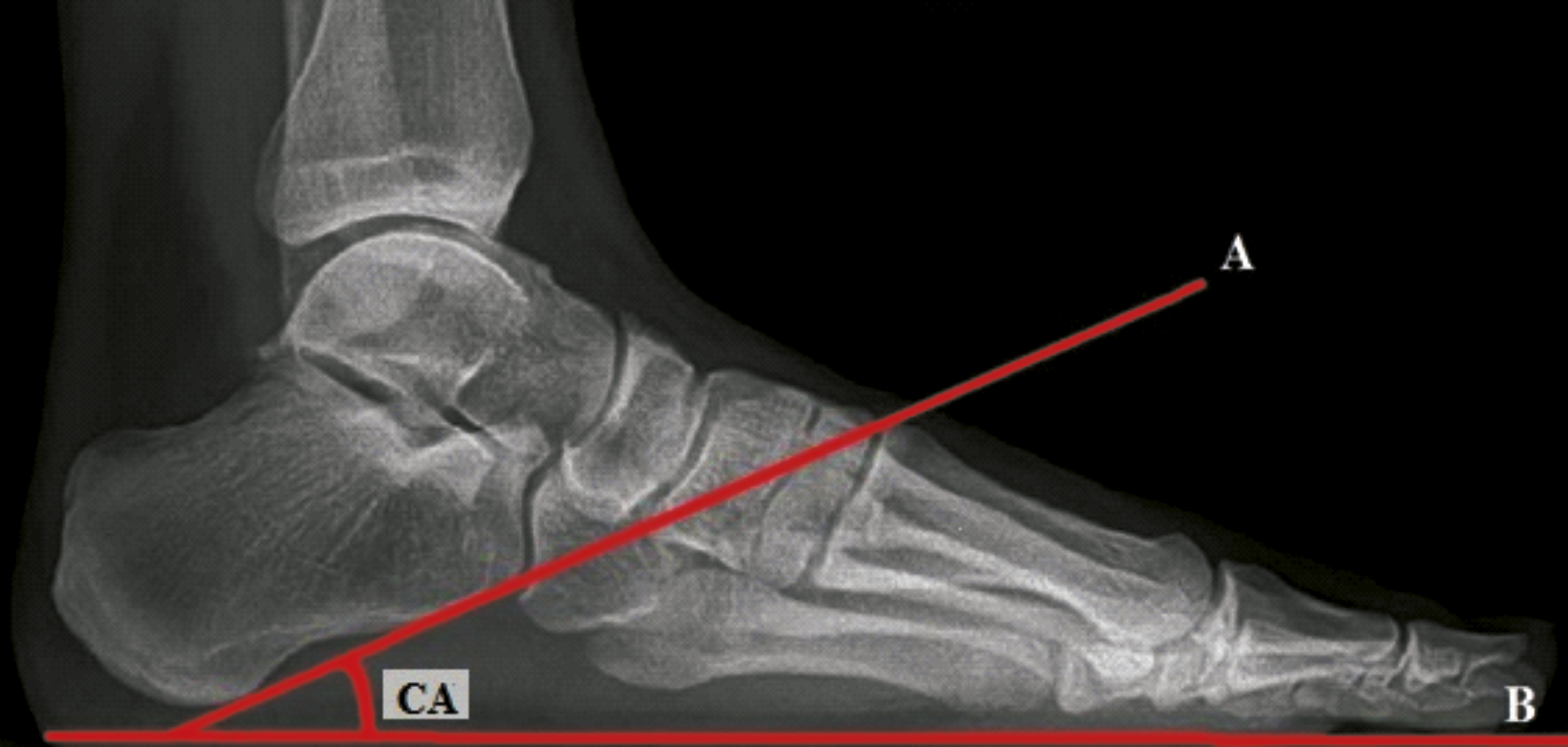 The Evaluation of Radiologic Angular Measurements in Patients with Foot ...