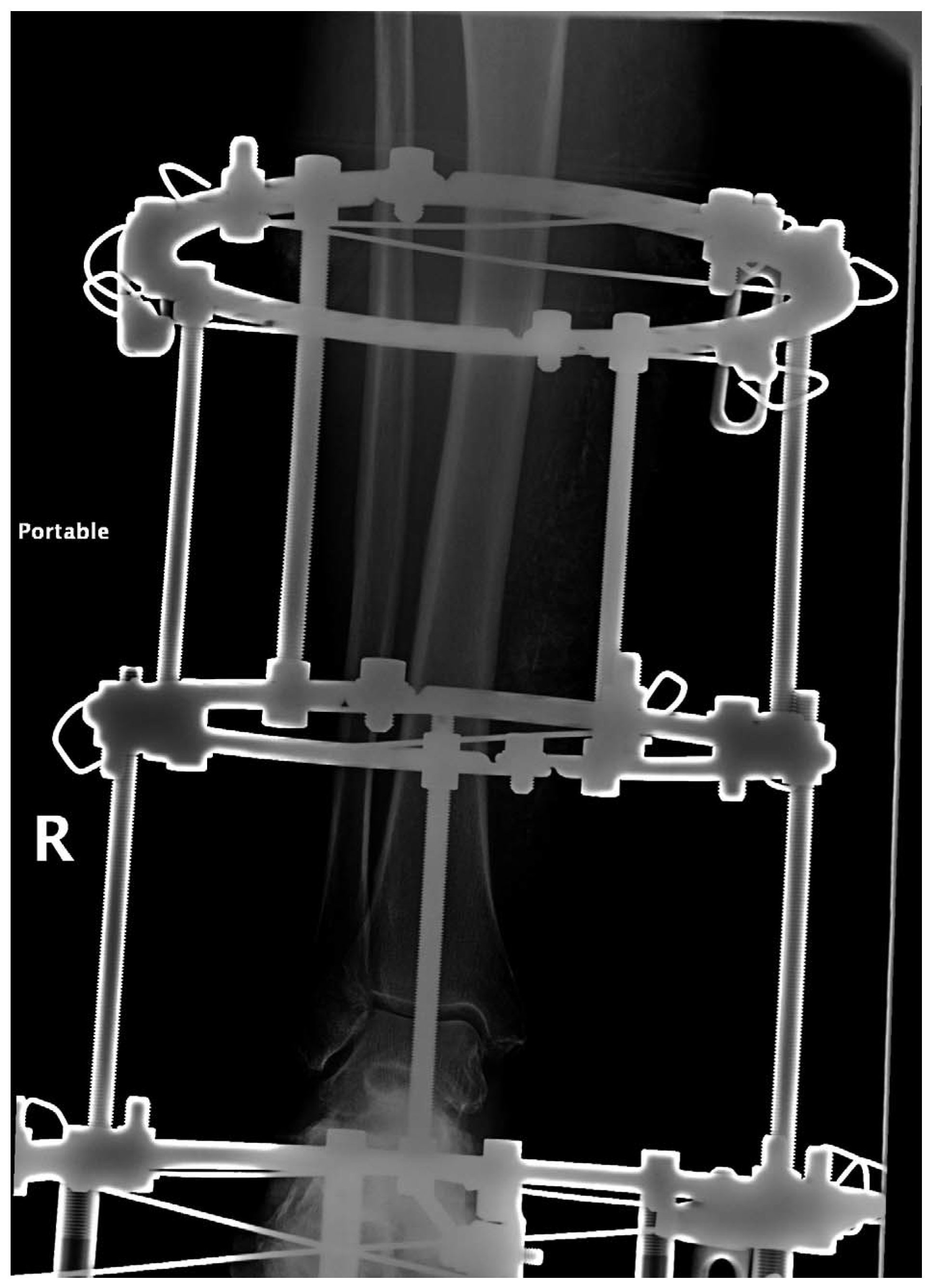 Tibia Fracture in Staged Limb Salvage Using External Ring Fixation and ...