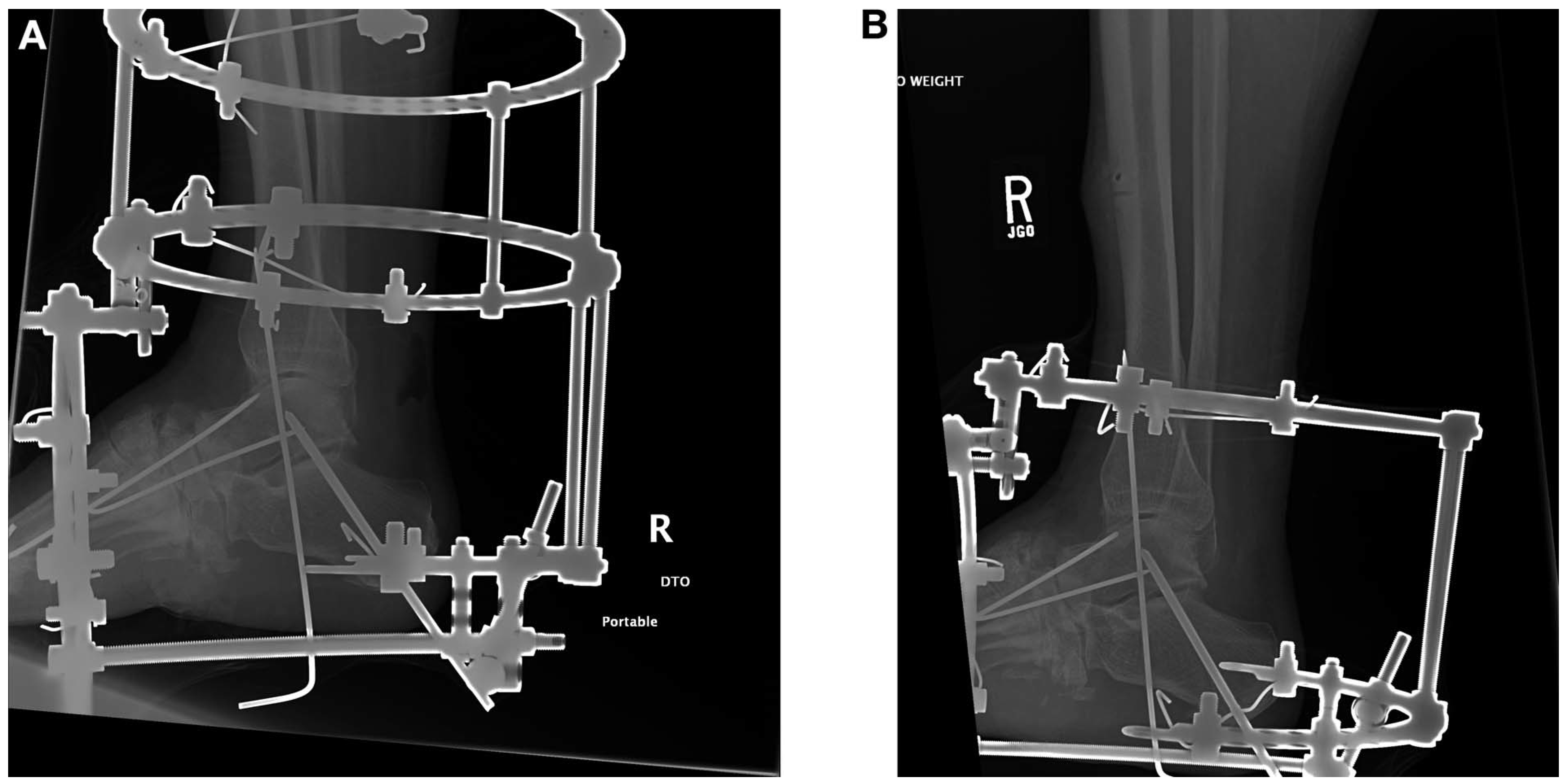 Tibia Fracture in Staged Limb Salvage Using External Ring Fixation and ...