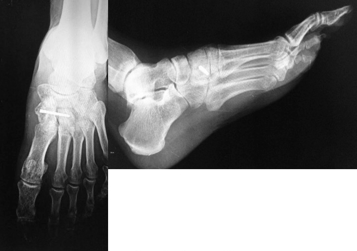 Aneurysmal Bone Cyst of the Medial Cuneiform: A Case Report