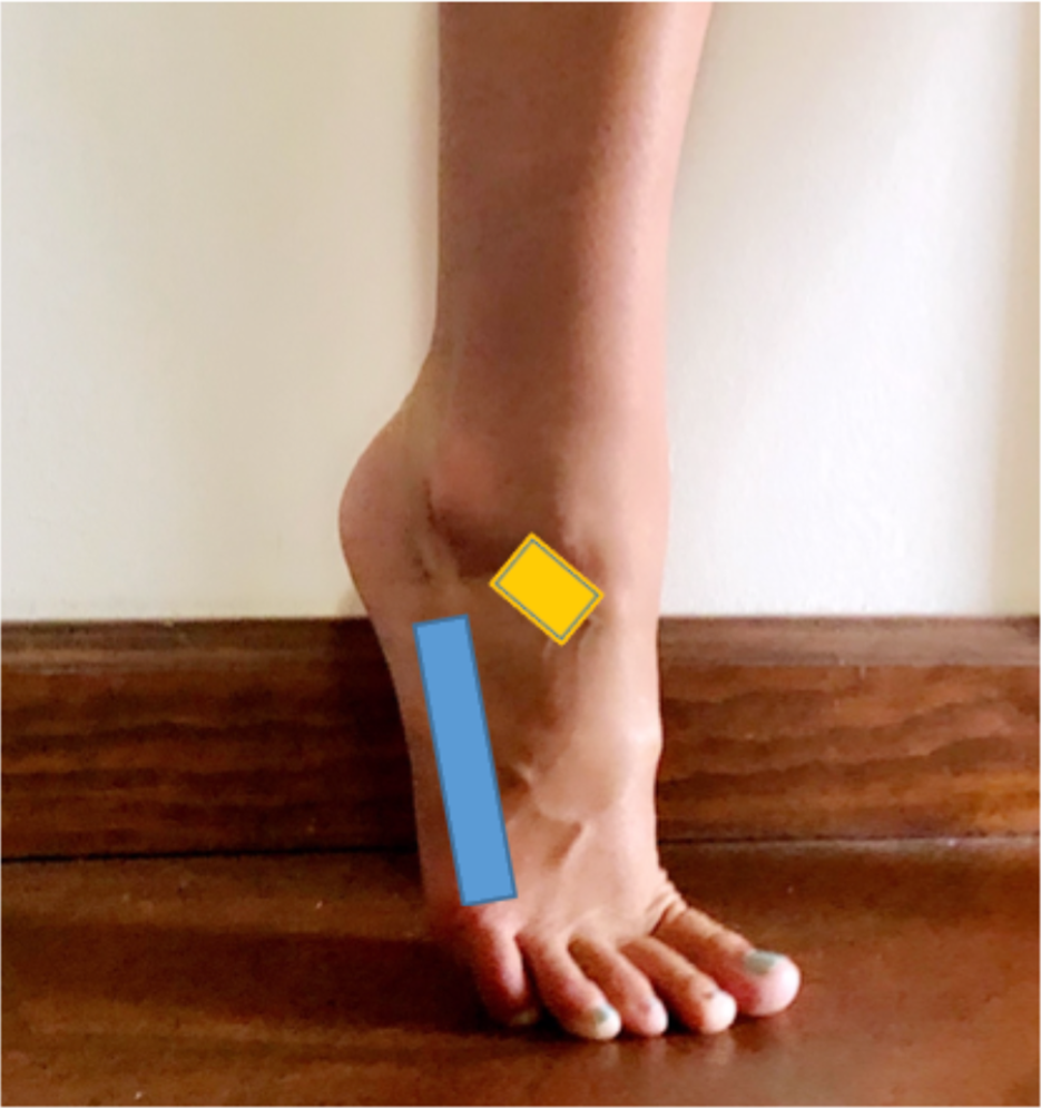 Qualitative Analysis of Risk Factors and Foot and Ankle Injuries in ...
