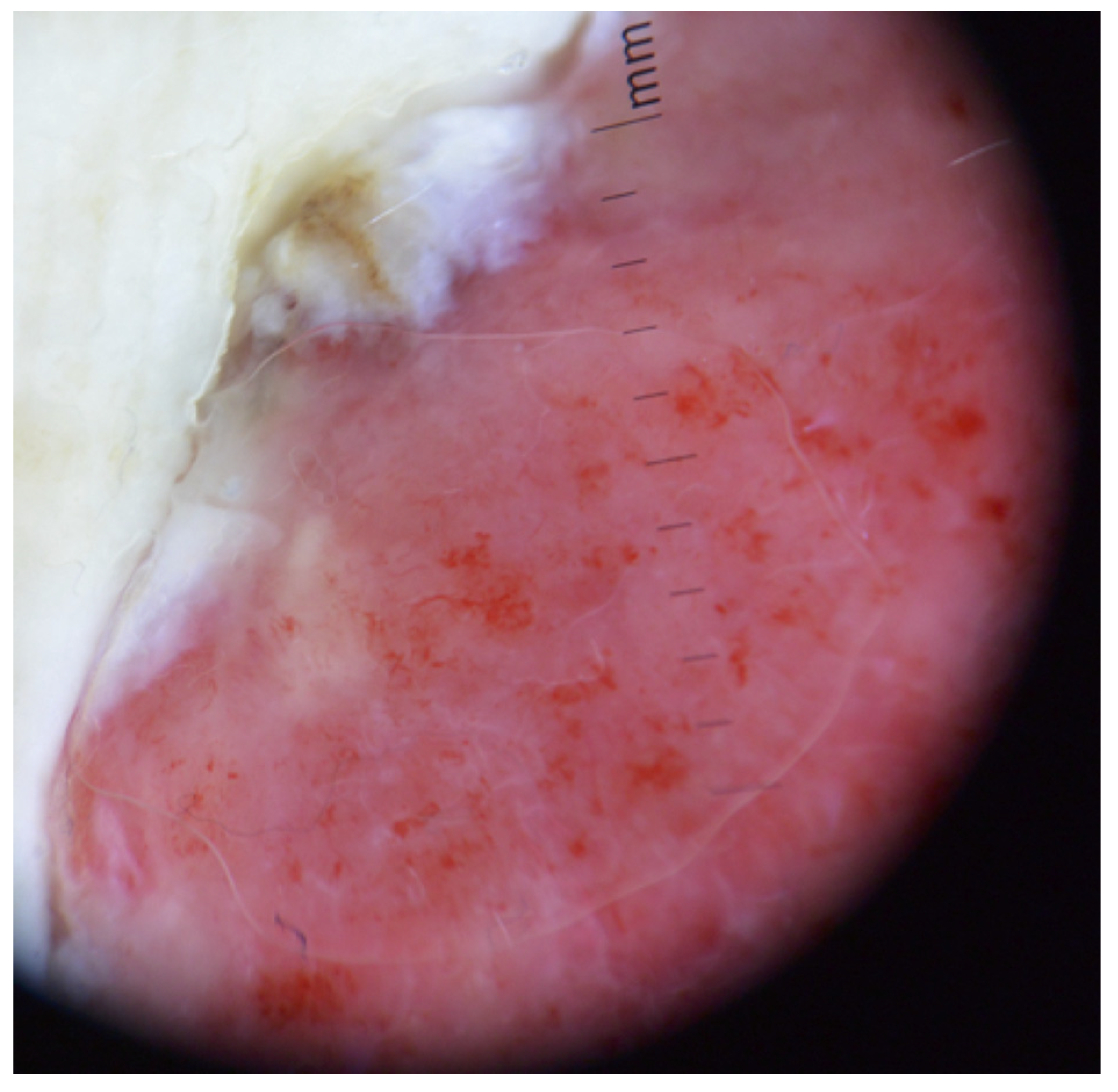 Dermoscopy for the Identification of Amelanotic Acral Melanoma