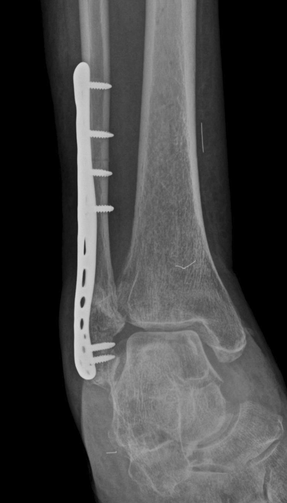 Staged Treatment for Unstable Open Fracture-Dislocation of the Ankle. A ...