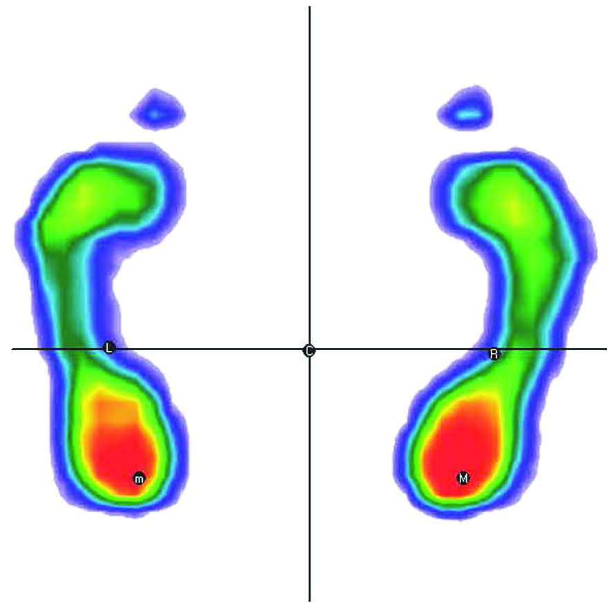Plantar Ridge Pattern New Distinct Component Patterns for Plantar Pressure Variables by Using ...