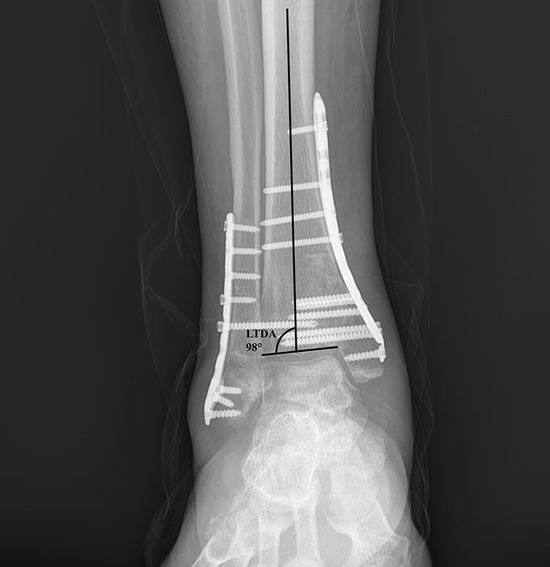 Supinated External Rotation Comparison of Supination-Adduction Type 2 and Supination–External ...