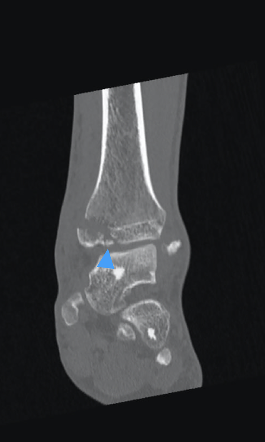 Supinated External Rotation Comparison of Supination-Adduction Type 2 and Supination–External ...
