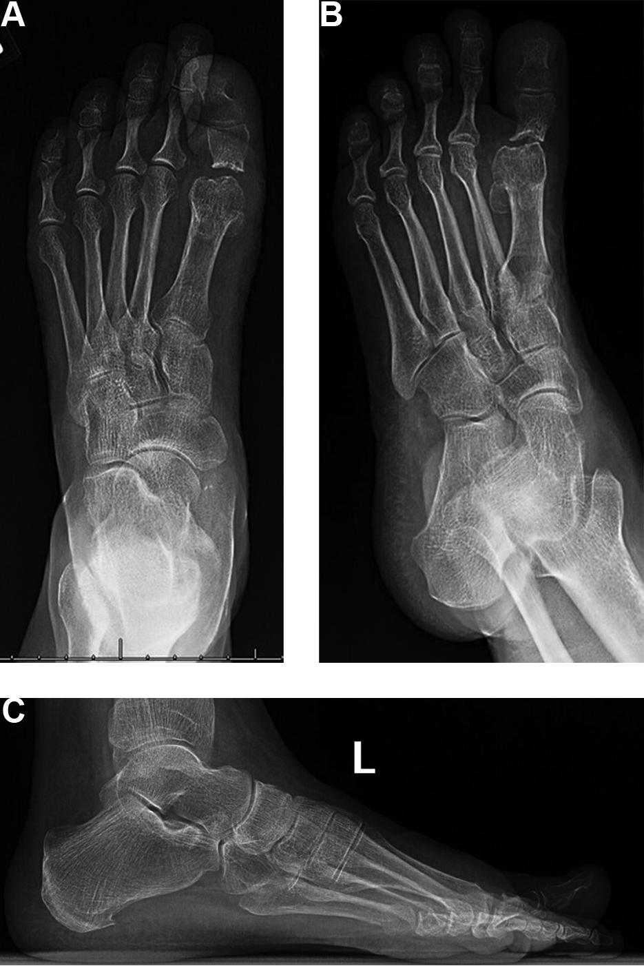 Novel Use of Diaphyseal Fibular Autograft for Revision Arthrodesis in ...