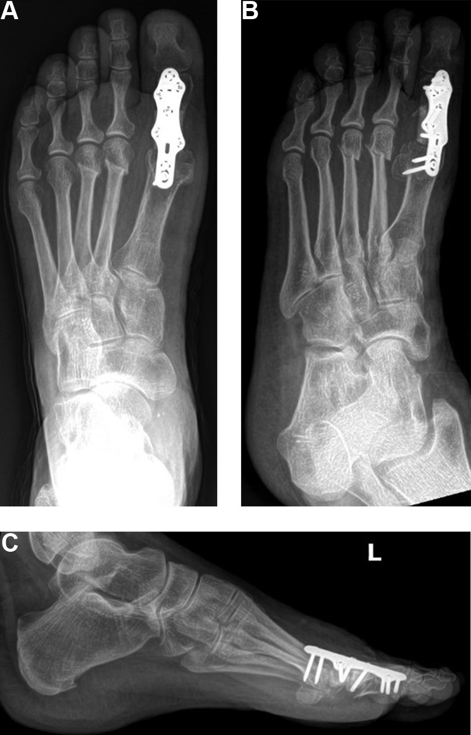Novel Use of Diaphyseal Fibular Autograft for Revision Arthrodesis in ...