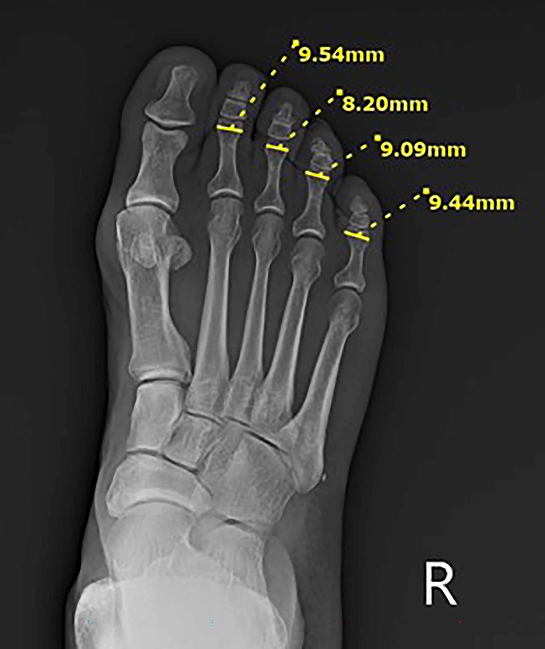 Toe Digit Radiograph Comparative Radiographic Analysis of the Width of the Lesser Digit ...