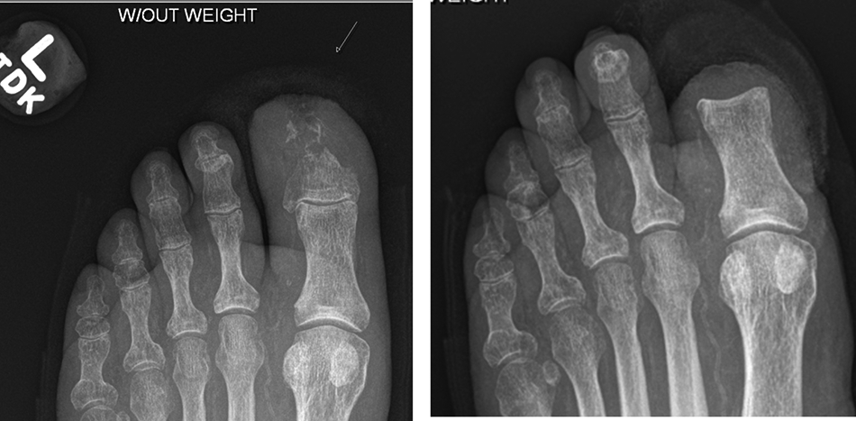 Toe Arthrogram Articular Cartilage After Toe Amputation—Protective Barrier or Source ...