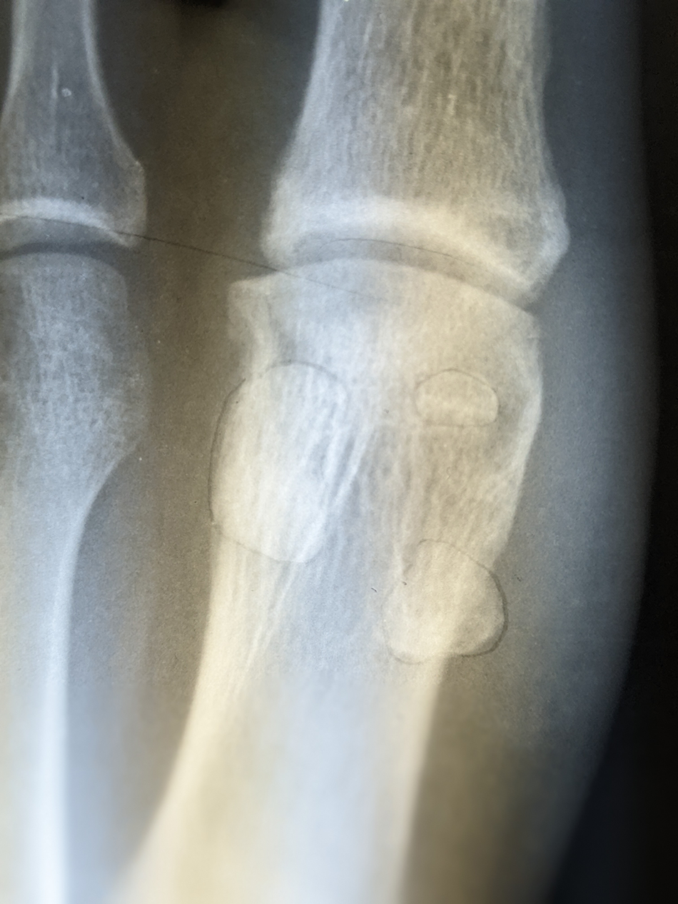 Grade III Turf Toe Injury in a Cowboy