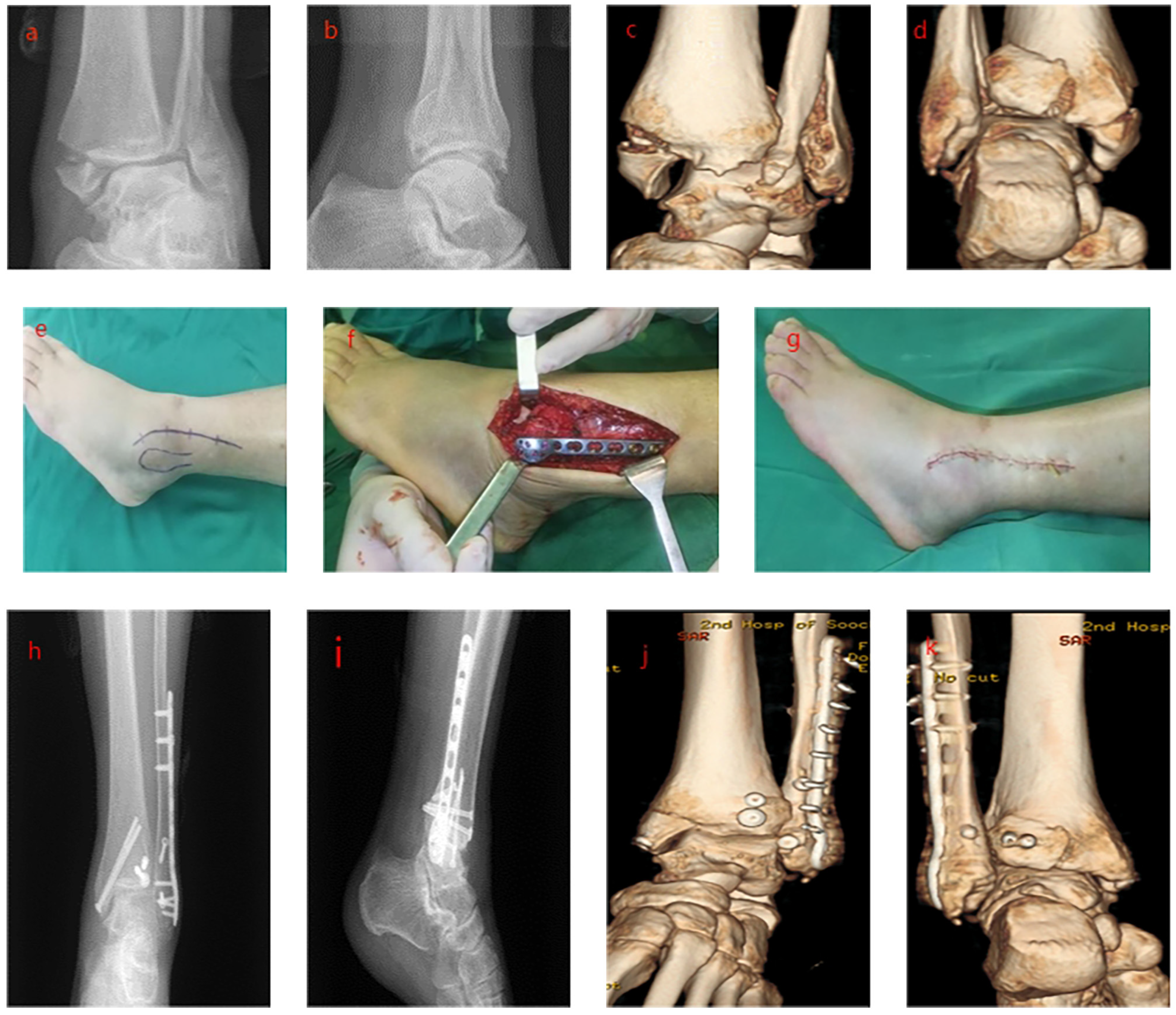 External Rotation Ankle Open Reduction and Internal Fixation for Supination-External Rotation ...