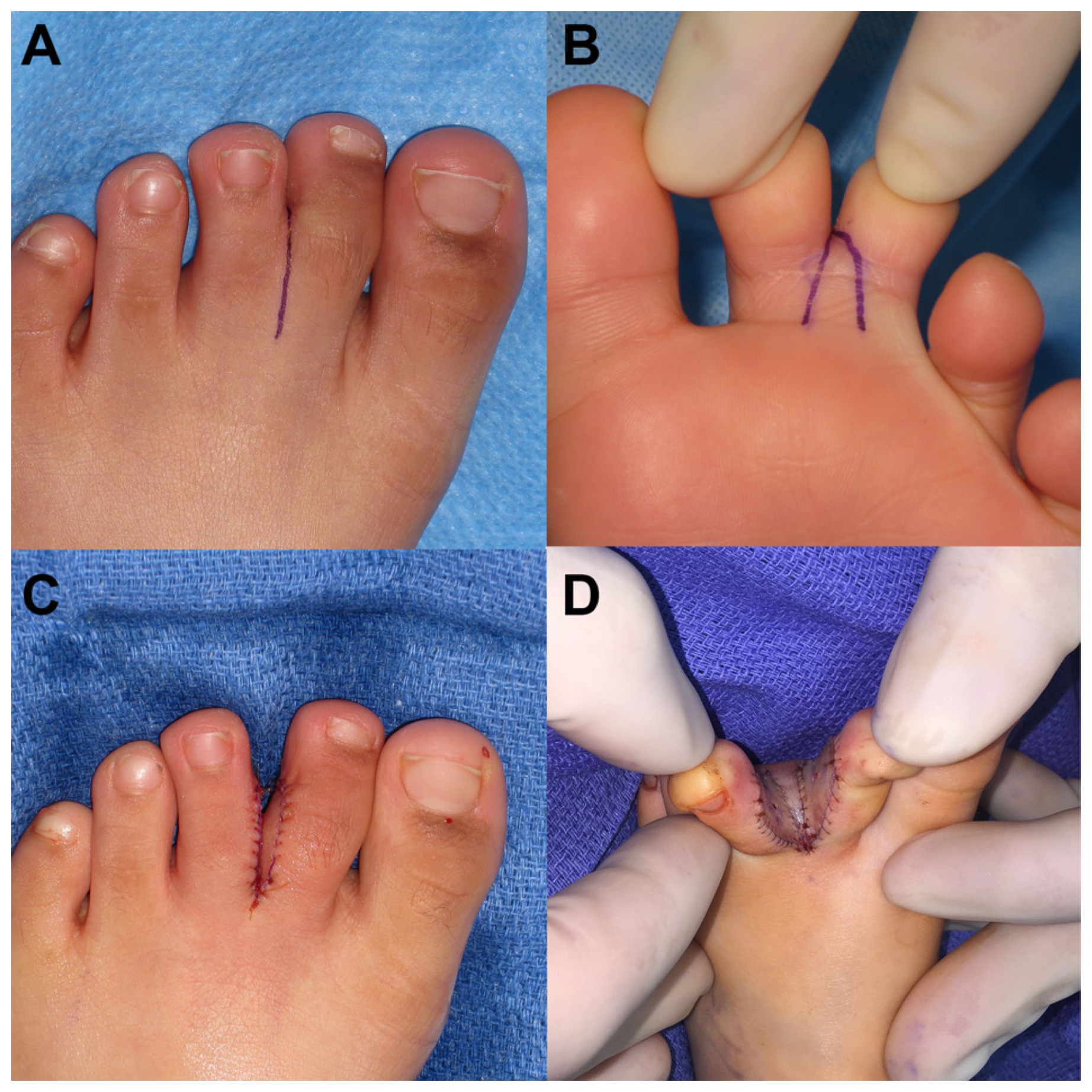 Triangular Toe Ditch Patient-Reported Outcomes After Congenital Toe Syndactyly Repair with a ...
