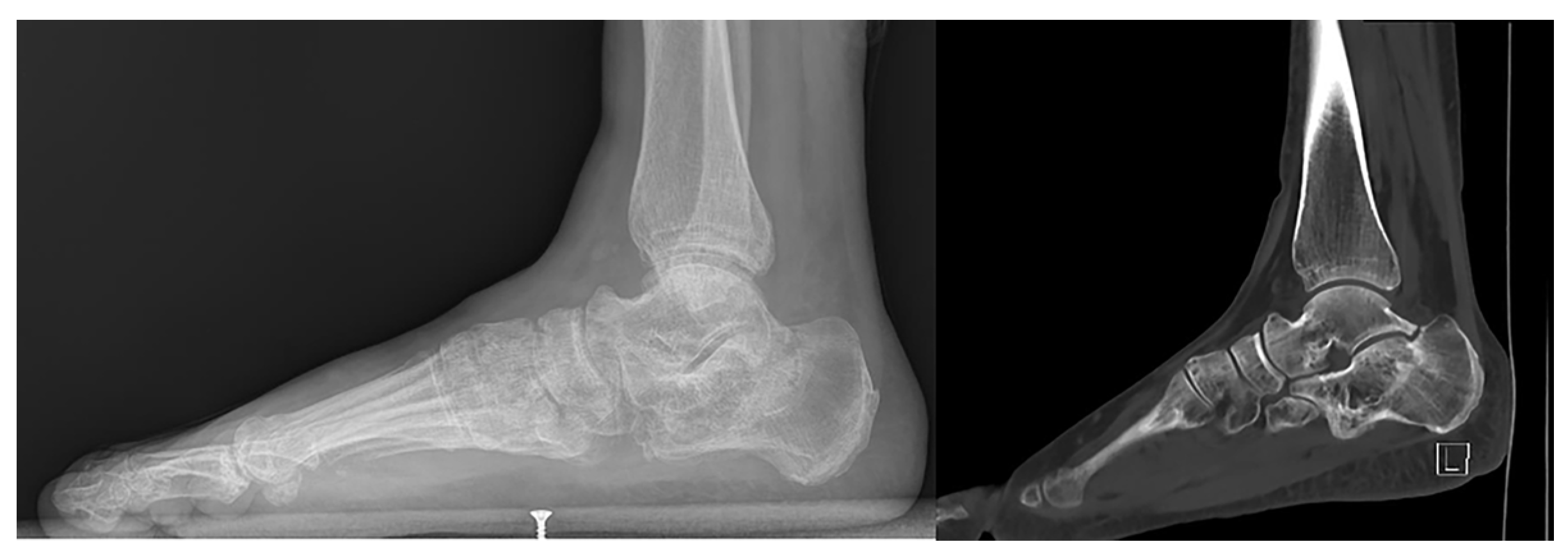 Endoscopy-Assisted Minimally Invasive Calcaneus Osteotomy in Calcaneus ...