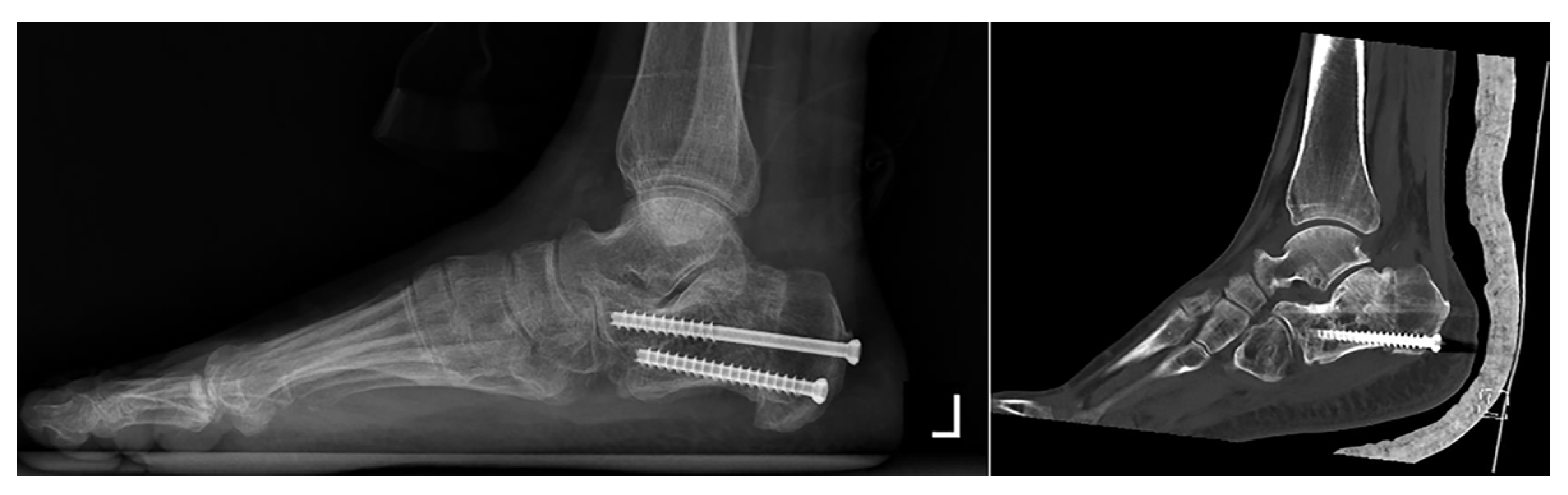 Endoscopy-Assisted Minimally Invasive Calcaneus Osteotomy in Calcaneus ...