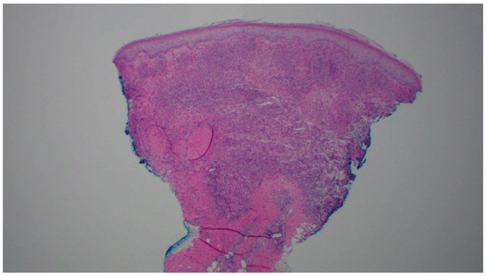 Pyoderm Foot Intersection of Diabetic Foot Infection and Pyoderma Gangrenosum: A ...
