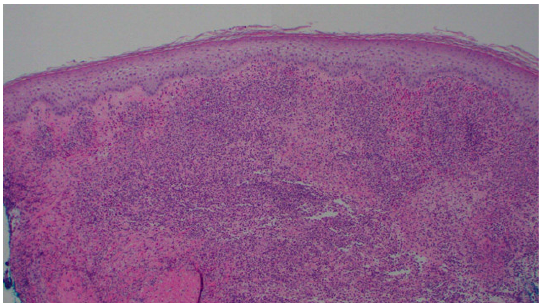 Pyoderm Foot Intersection of Diabetic Foot Infection and Pyoderma Gangrenosum: A ...