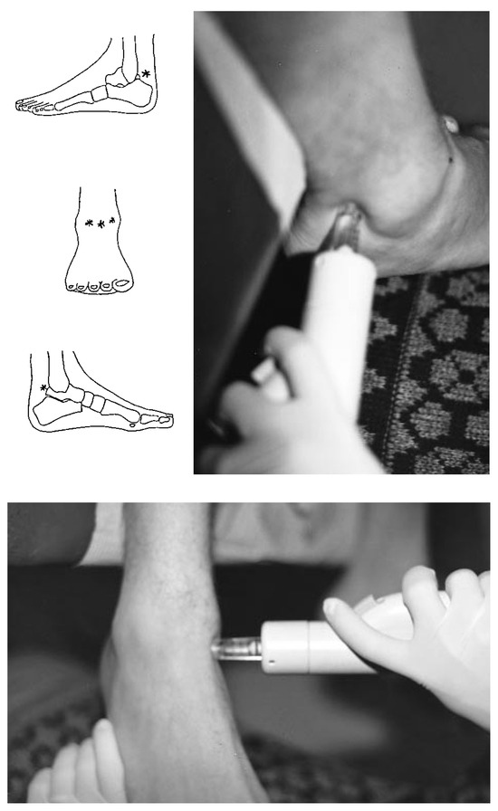 Anesthesia Blocks of the Lower Extremity. Comparing the Biojector® With ...