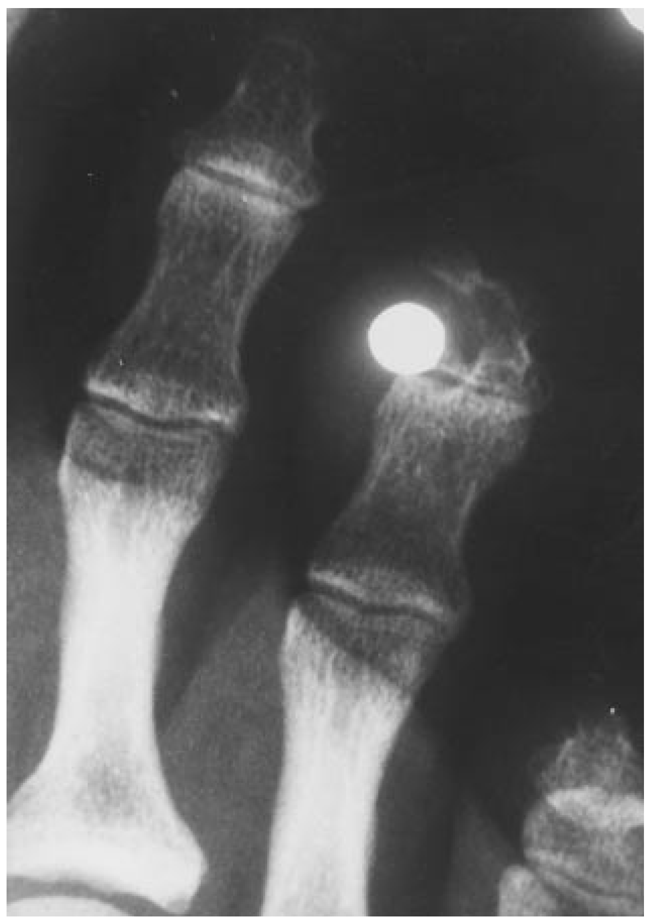 Retained Digital Foreign Body After a Pellet Gun Injury