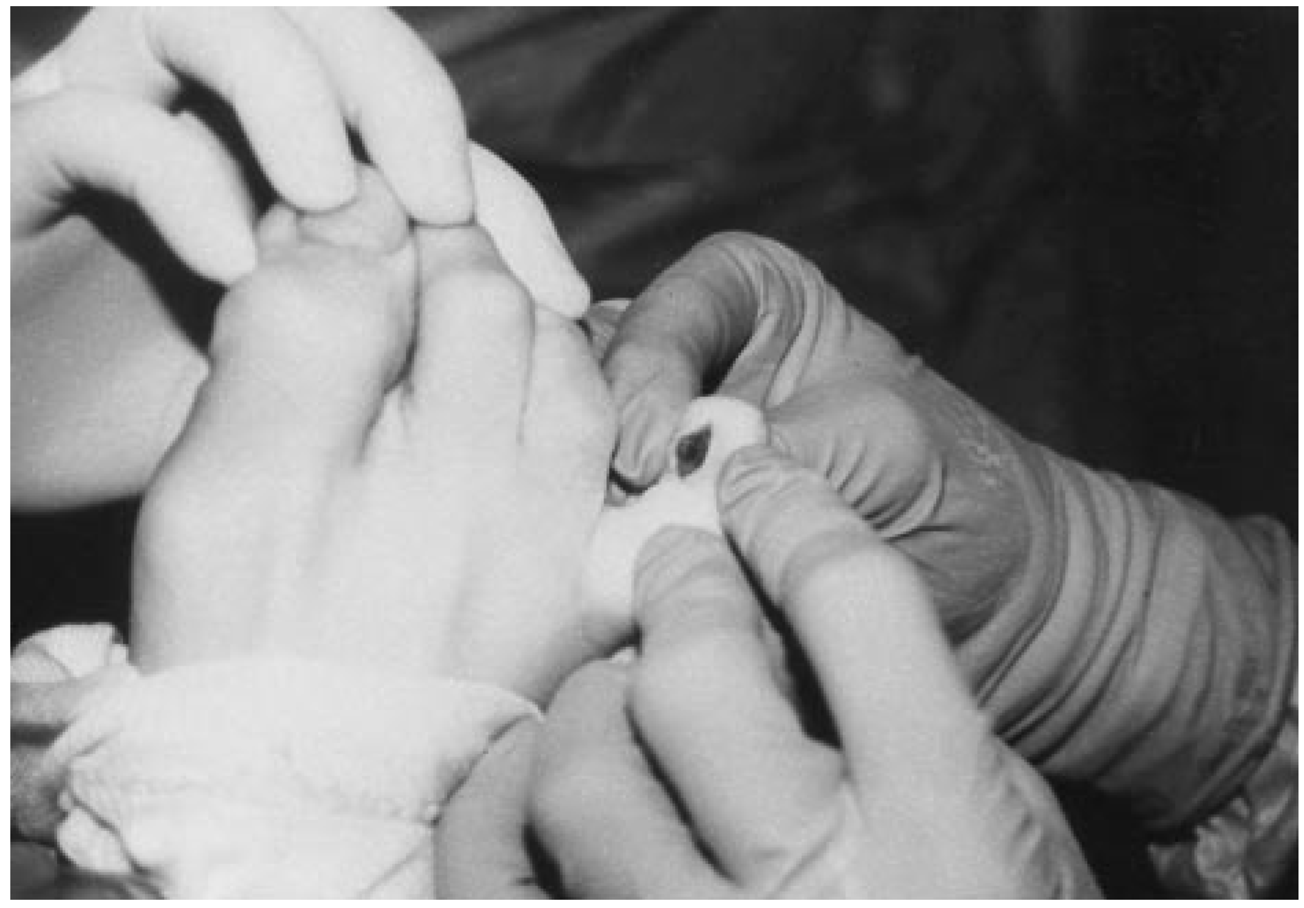 Retained Digital Foreign Body After a Pellet Gun Injury